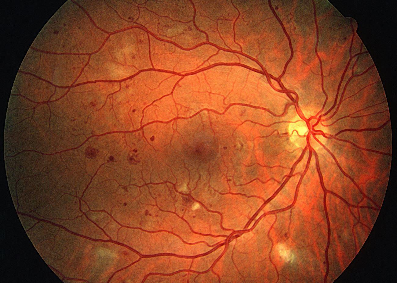 Состояние сетчатки. Препролиферативная ретинопатия. Цитомегаловирусный хориоретини. Центральная серозная ретинопатия. Ретинопатия хориоретинит.