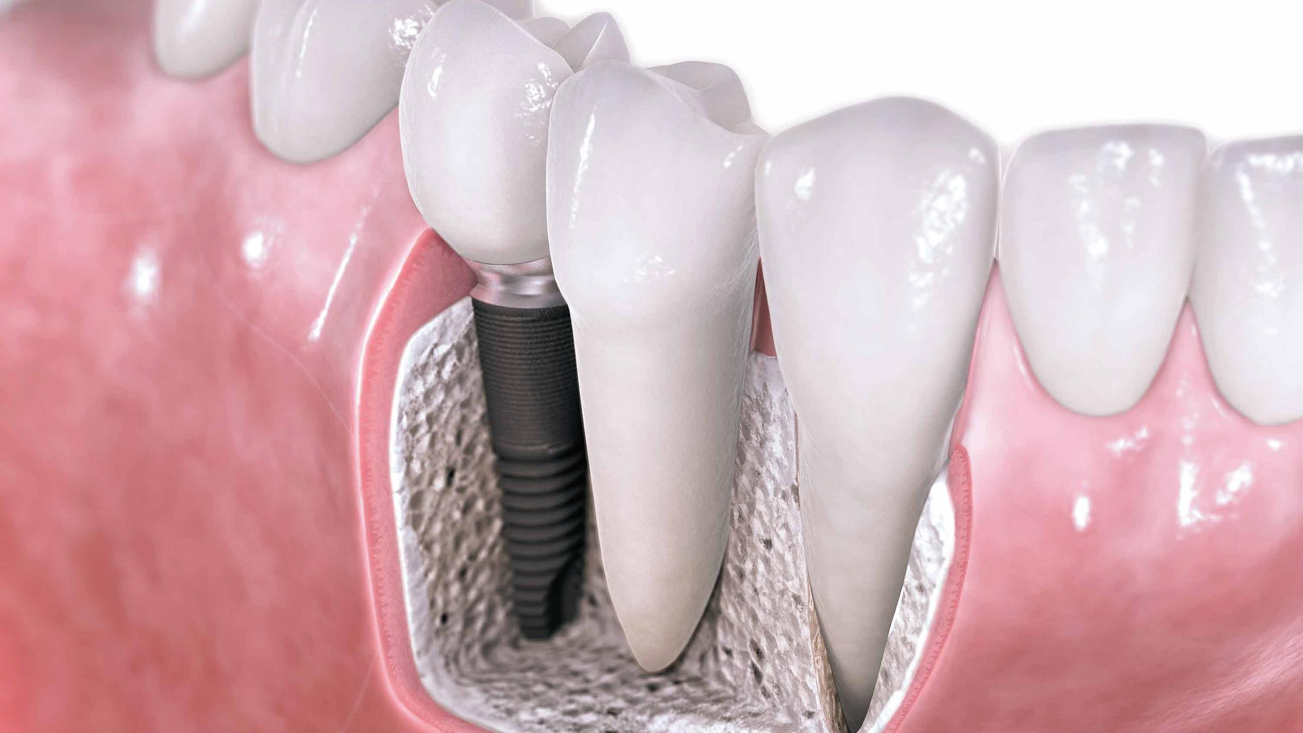 Созданы зубные импланты, которые способны сами врастать в кость