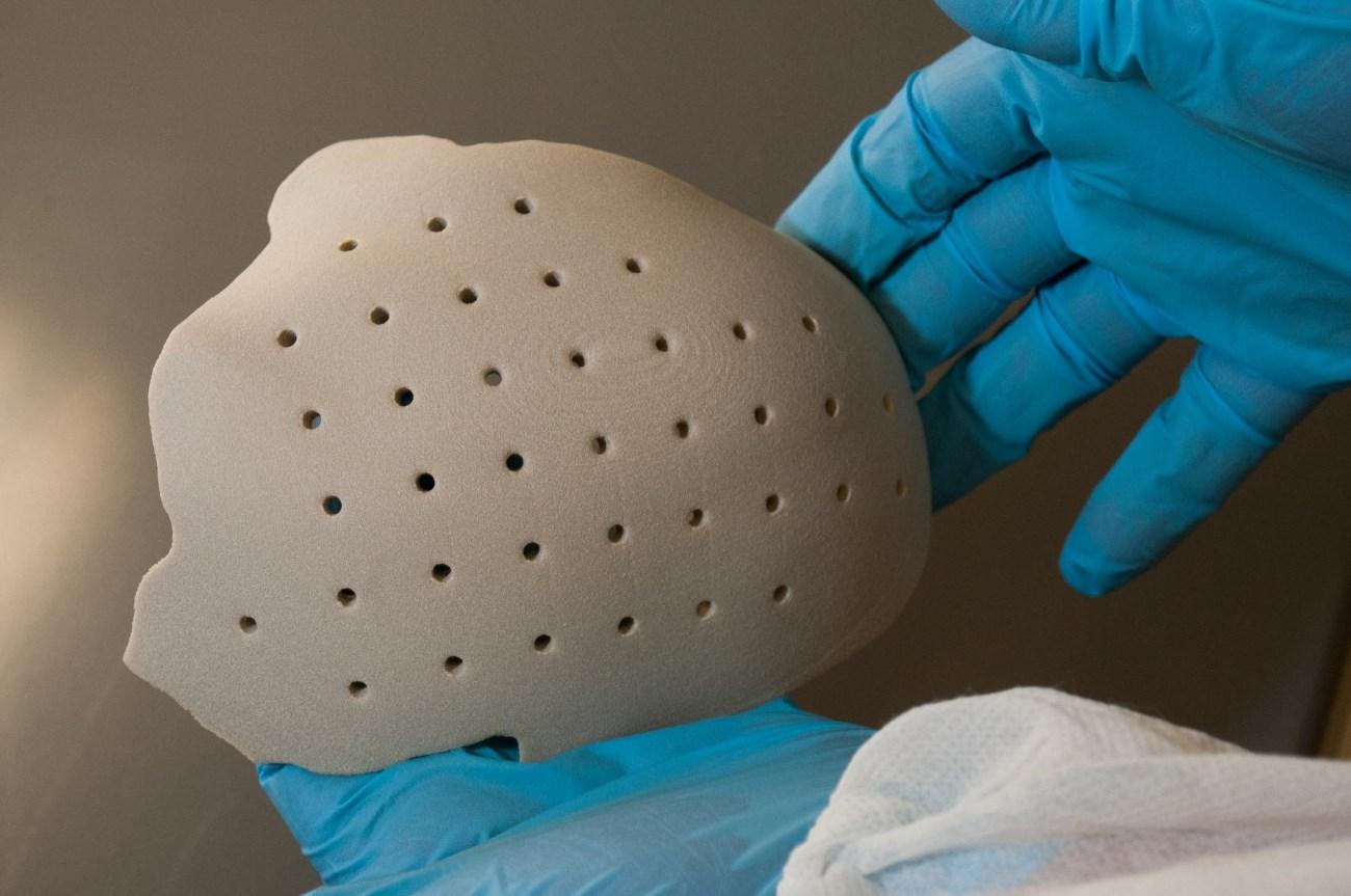 Пациенту восстановили 75% поврежденного черепа благодаря 3D-печати