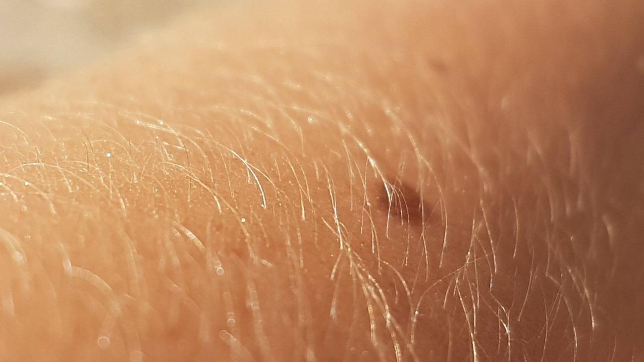 Компьютеры научились распознавать рак кожи