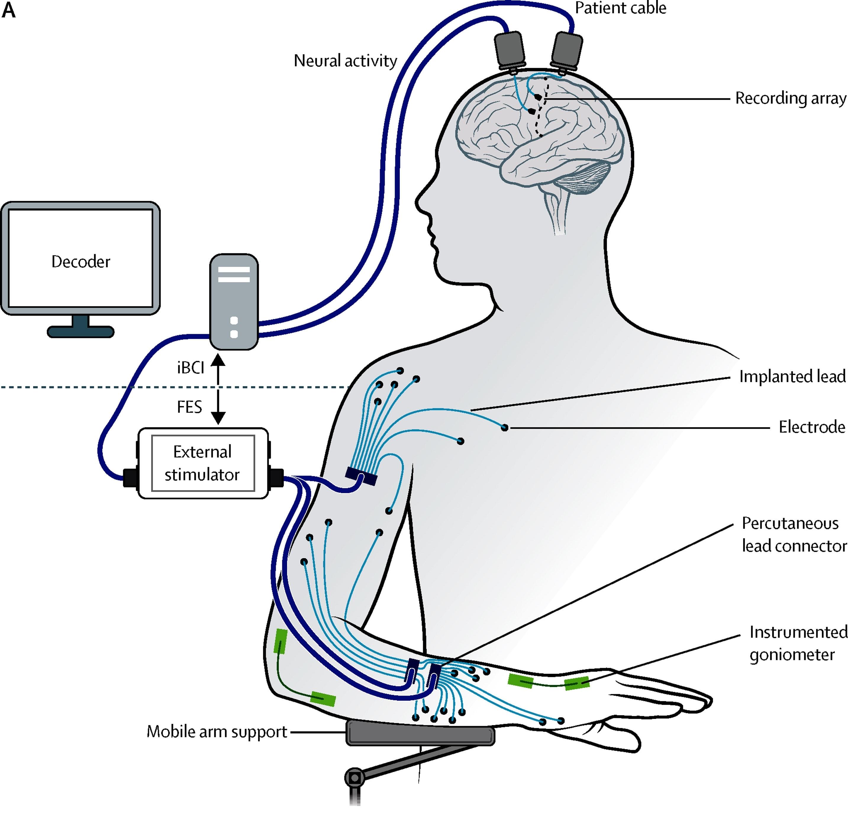 Интерфейс «мозг-компьютер» позволил управлять парализованной рукой