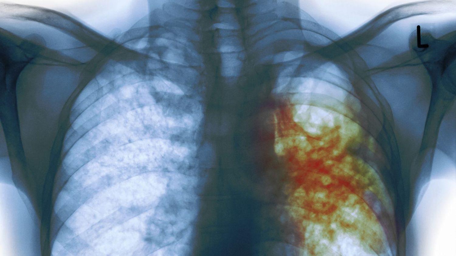 Вакцина от туберкулёза в кремниевая оболочке более термоустойчива