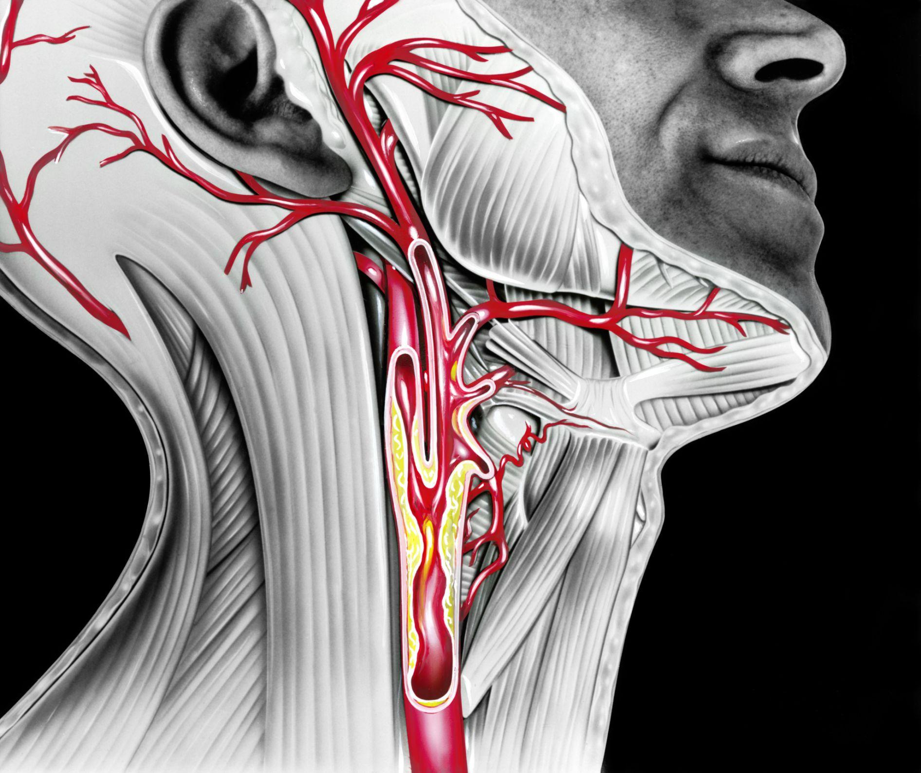 Где находится сонная артерия слева. Каротидная бифуркация. Анатомия сонных артерий шеи. Каротидная бифуркация сонной артерии.