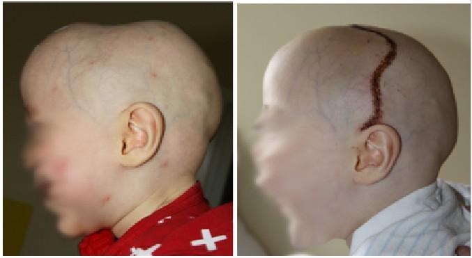 Черепно-лицевые хирурги выполнили операцию младенцу с врожденной деформацией черепа