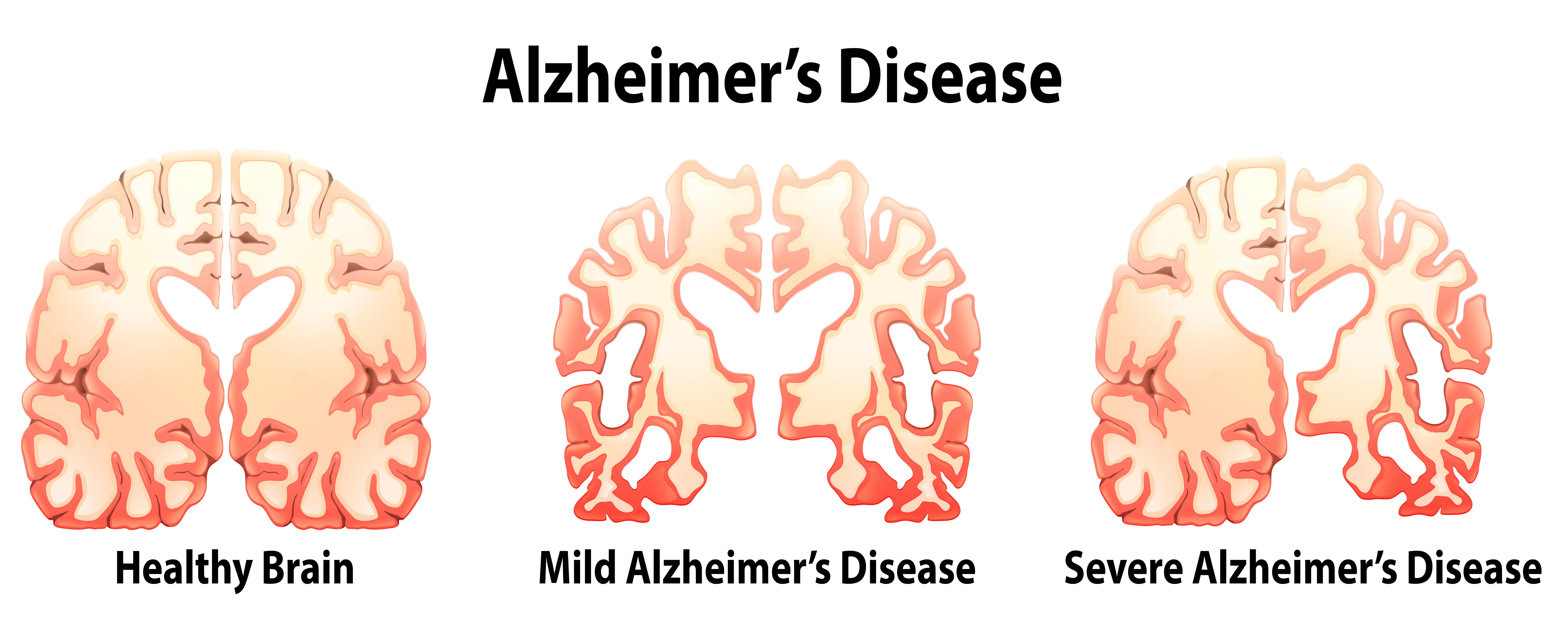 Компьютер научили предсказывать болезнь Альцгеймера