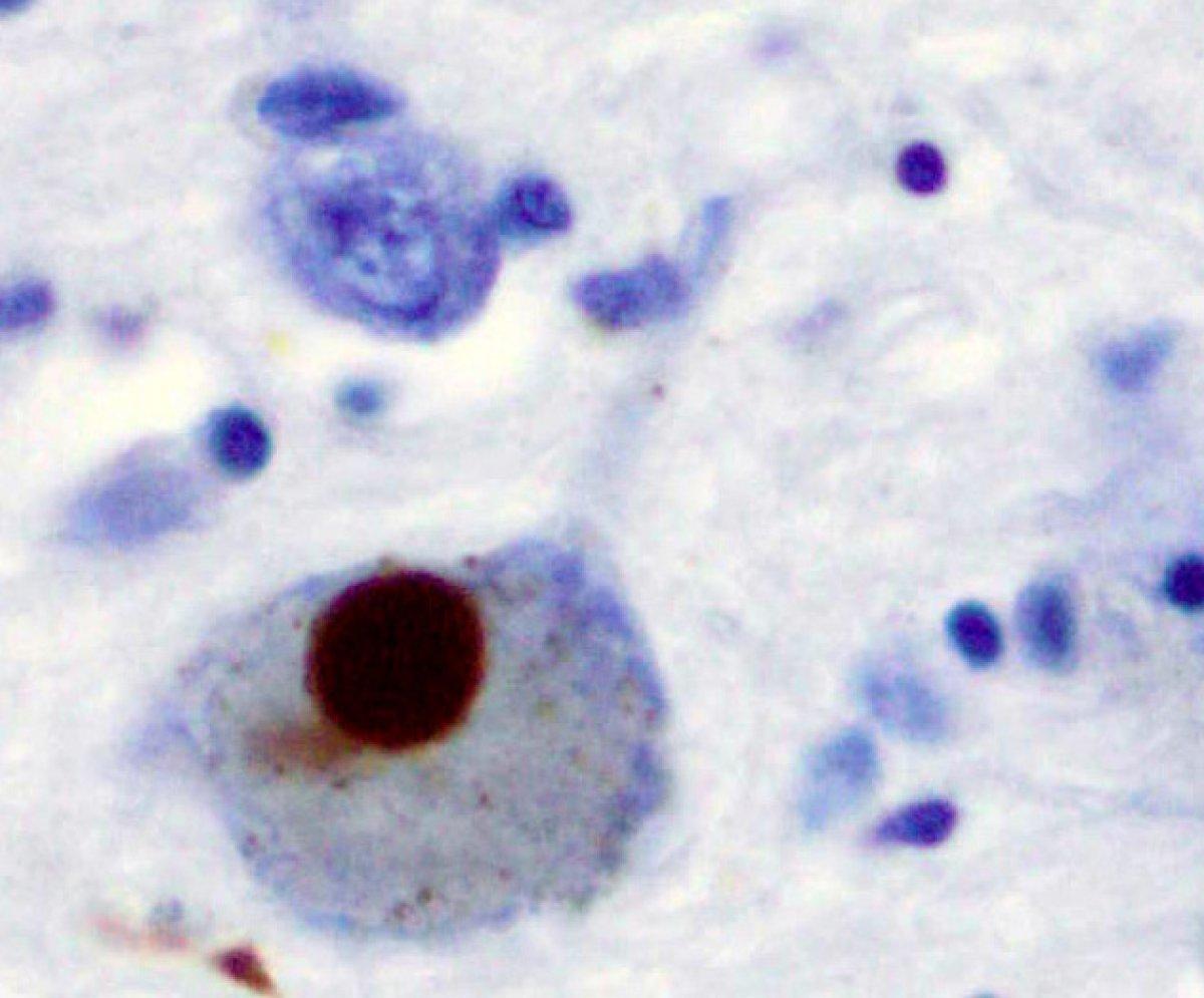 Ваготомия обнаружила связь между болезнью Паркинсона и пищеварительным трактом