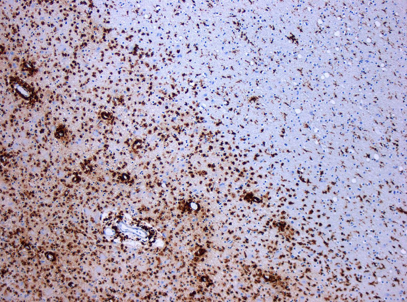 Рассеянный склероз: кто убийца нервных волокон?