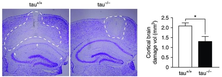Тау-белок влияет на постепенное омертвение нейронов после инсульта