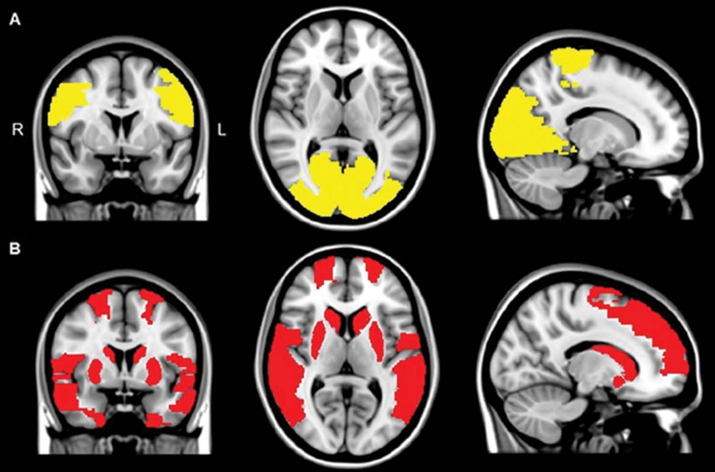 Галлюцинации при болезни Паркинсона связали с нарушением нейронных связей
