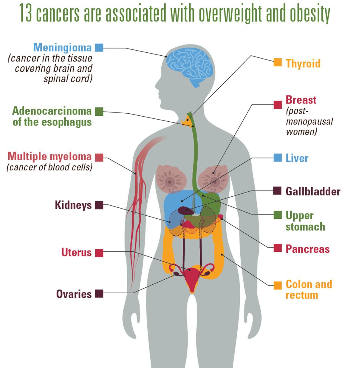 Возникновение 13 видов рака связано с избыточным весом
