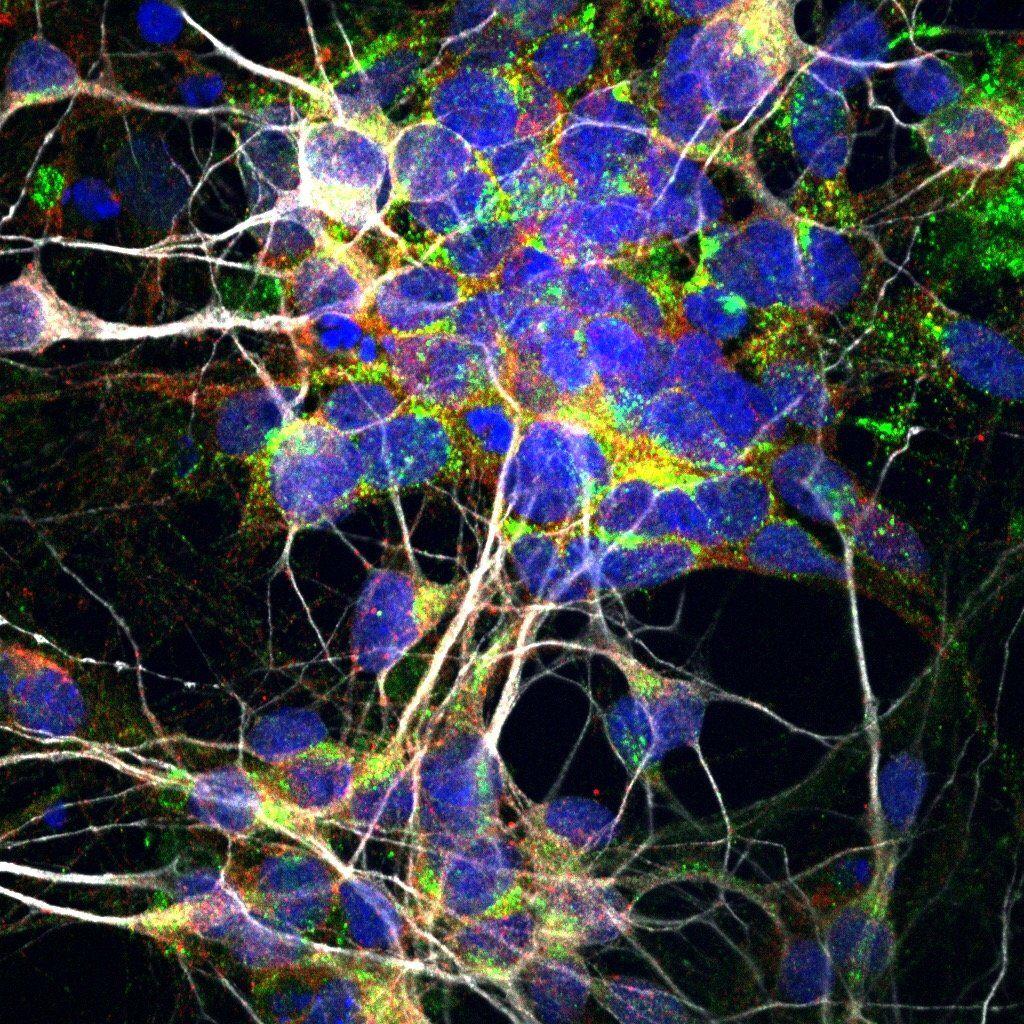 При боковом амиотрофическом склерозе нейроны погибают от «мусора»