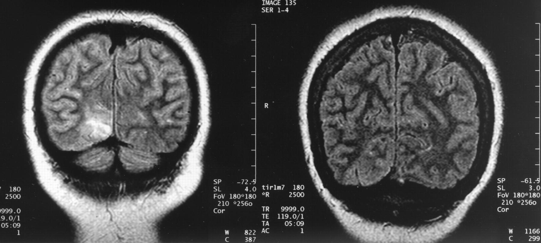 Причина тяжелой эпилепсии – в неправильном превращении клеток