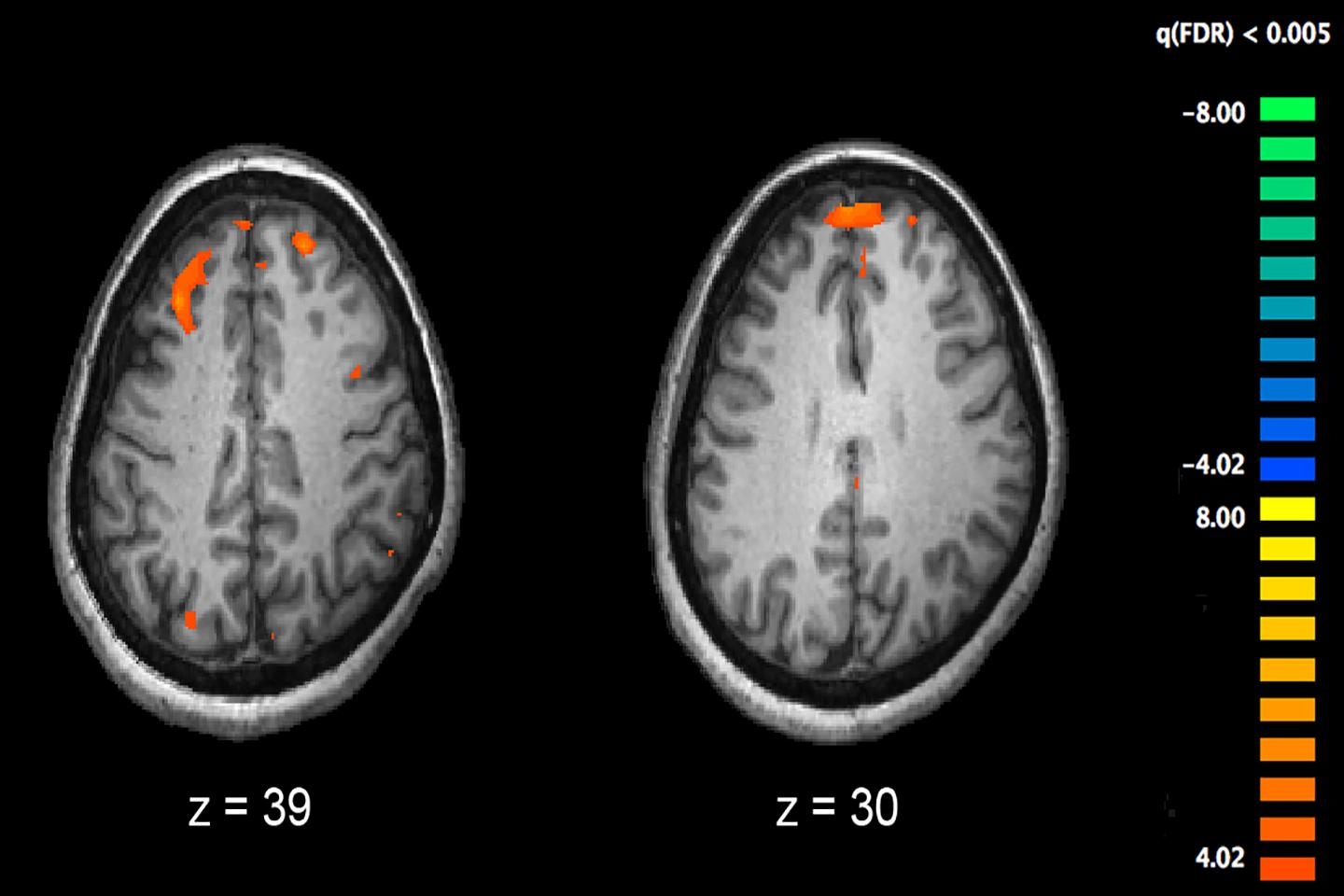 Стимуляция мозга может использоваться для лечения когнитивных нарушений при шизофрении