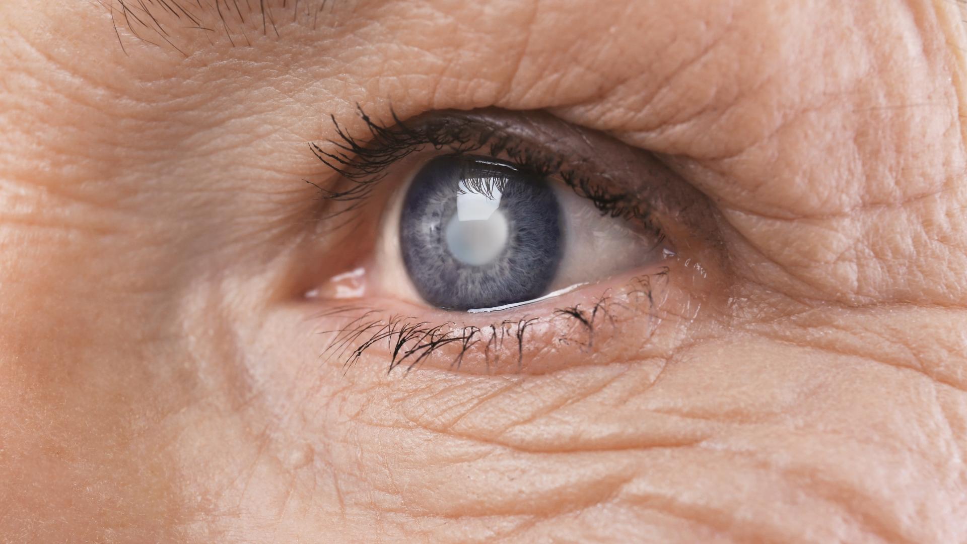 Экспериментальные глазные капли растворяют катаракту