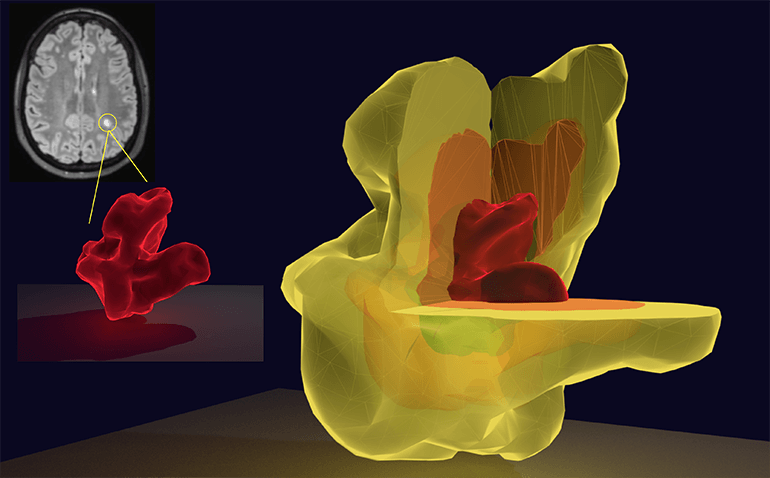 Об активности рассеянного склероза расскажет форма очага в 3D