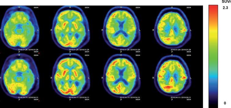 Транскраниальная стимуляция повернула болезнь Альцгеймера вспять