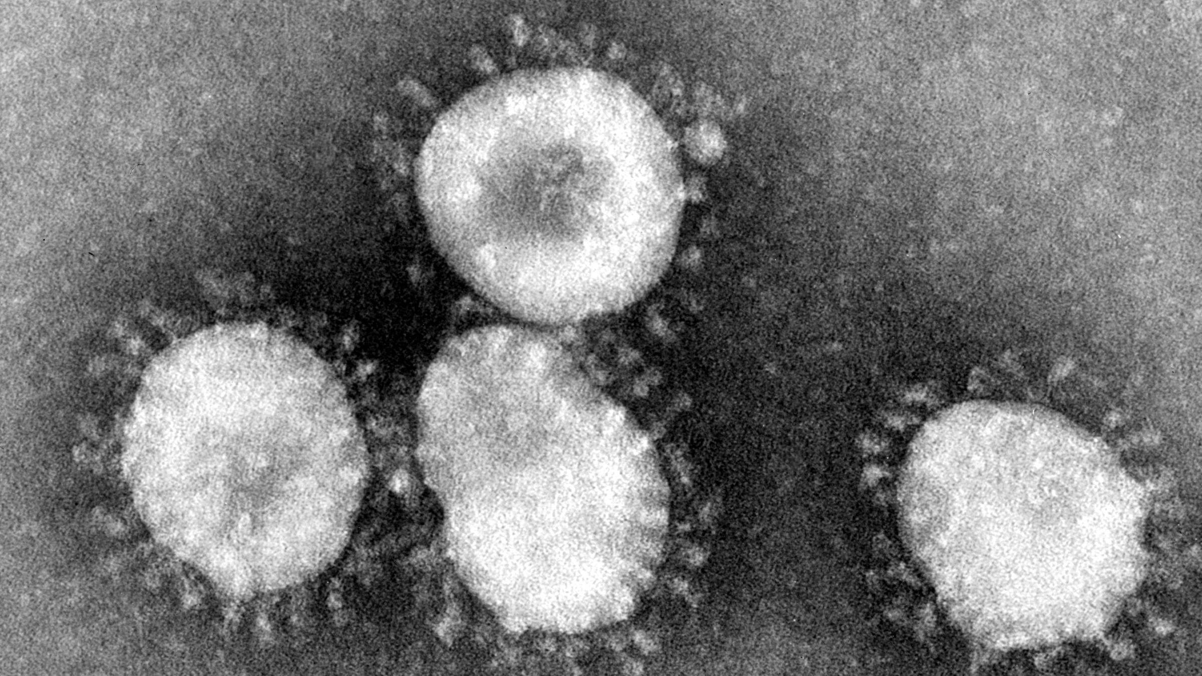 Что будет если заболеть коронавирусом: симптомы, тяжесть, течение
