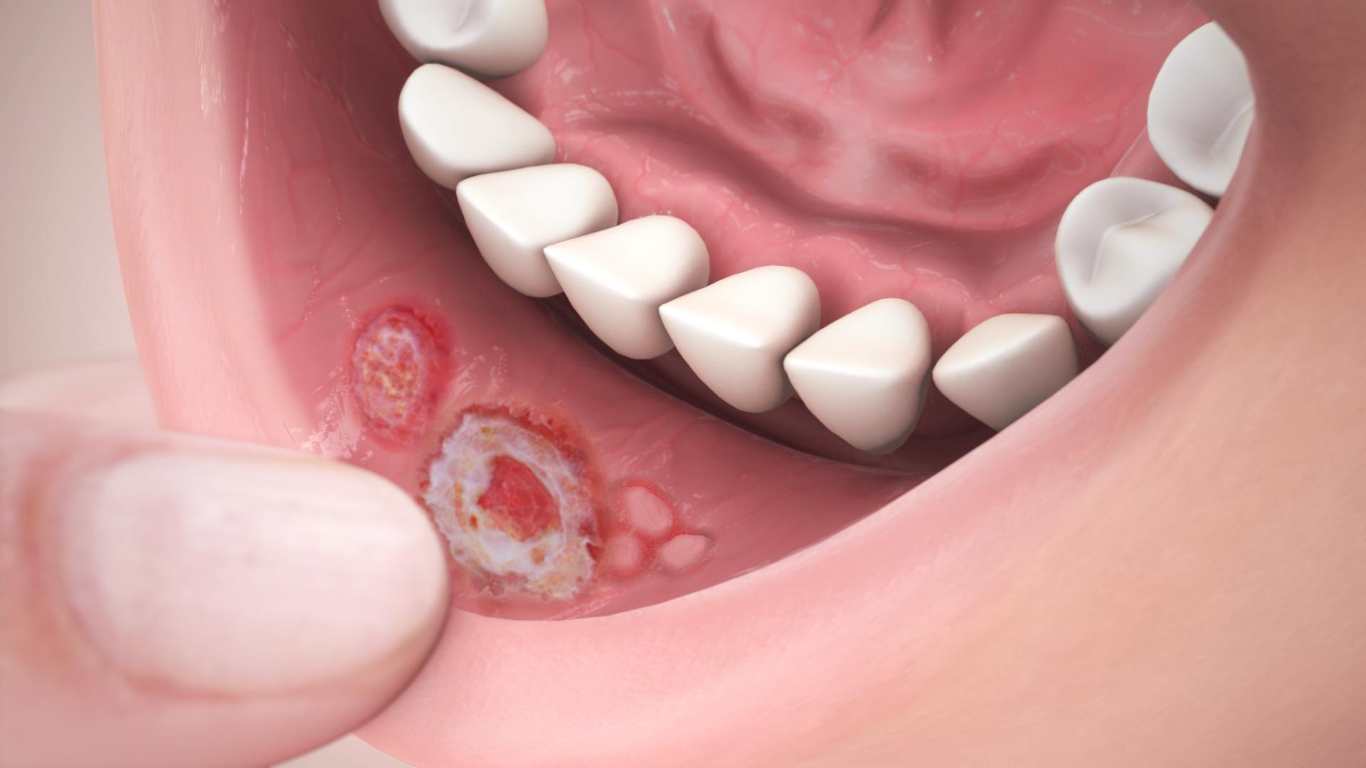 8 советов, которые помогут избежать рака полости рта