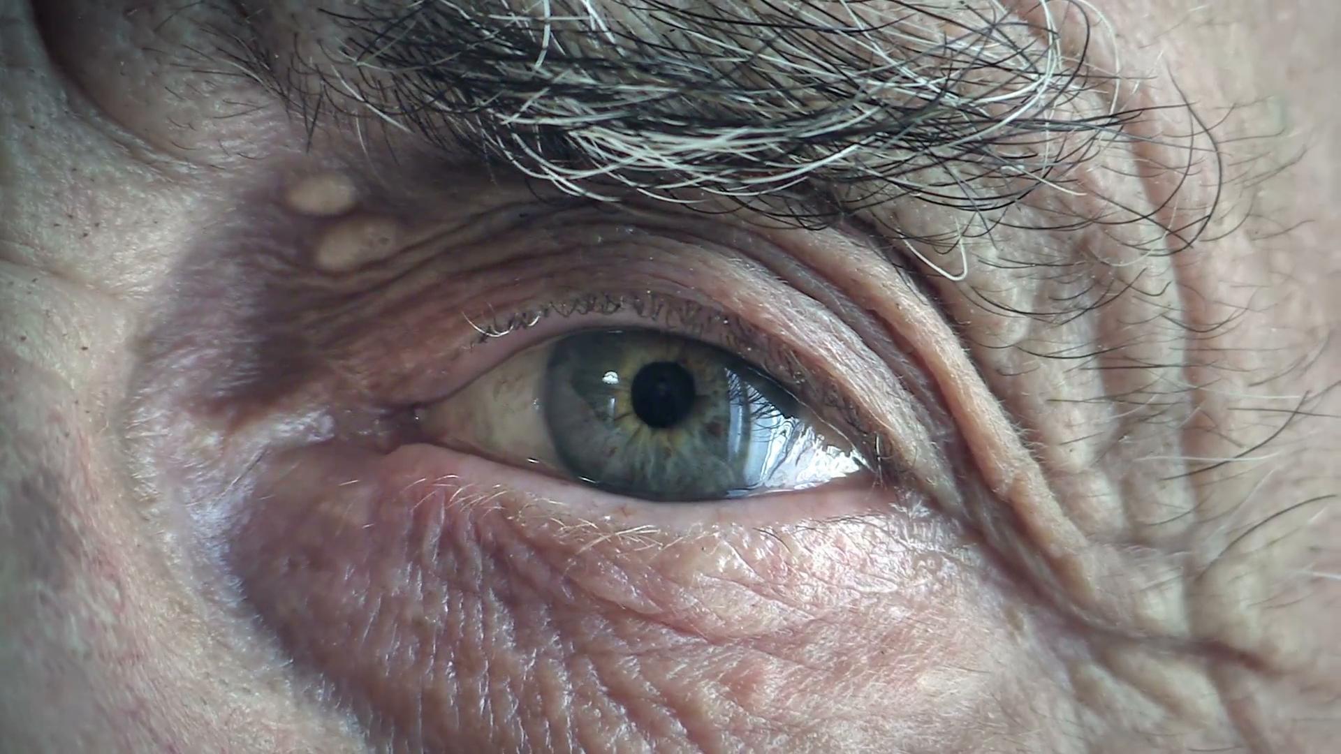 SARS-Cov-2 нашли в глазах 64-летней пациентки через два месяца после выздоровления