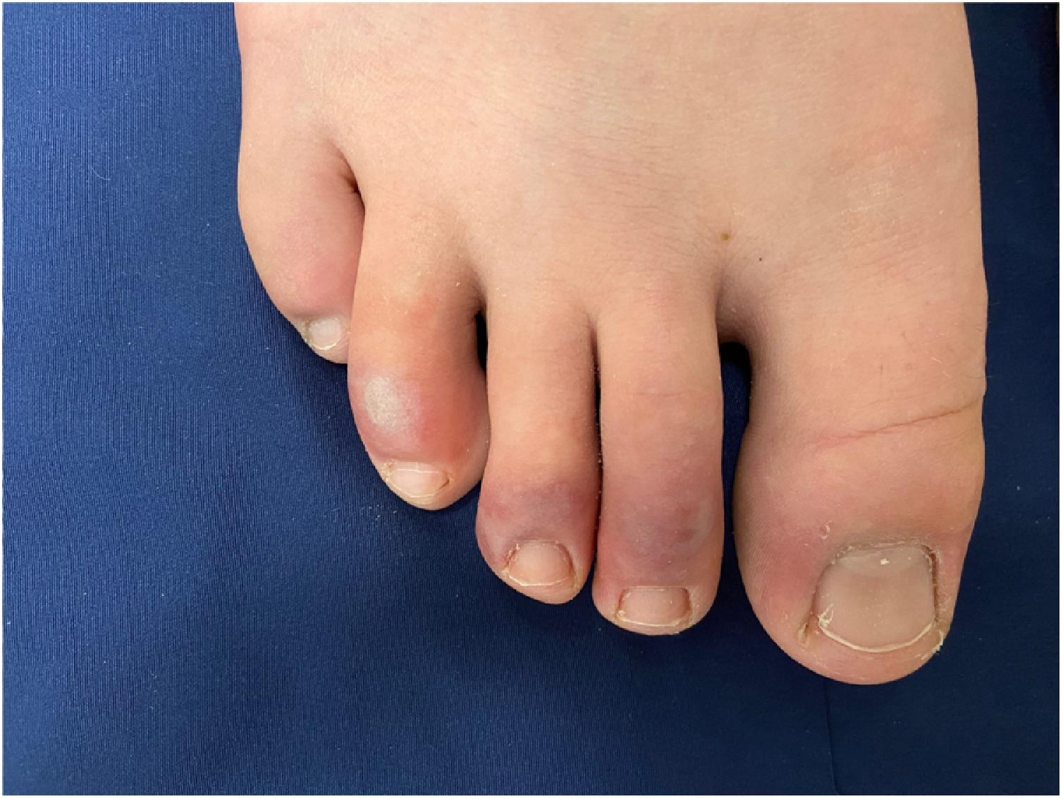 Фиолетовые пальцы — еще один симптом коронавируса?