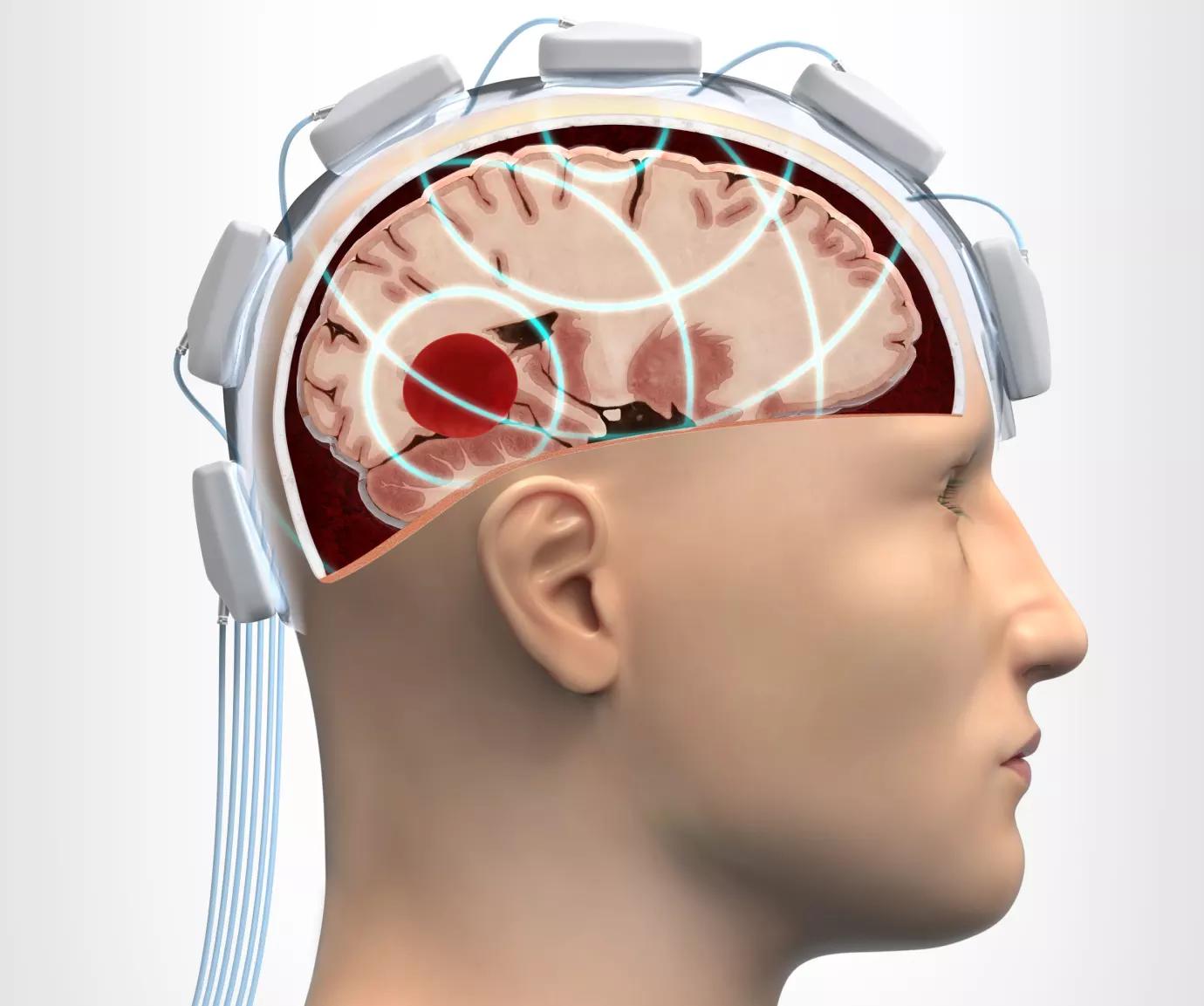 Микроволновой шлем ускорит диагностику черепно-мозговой травмы
