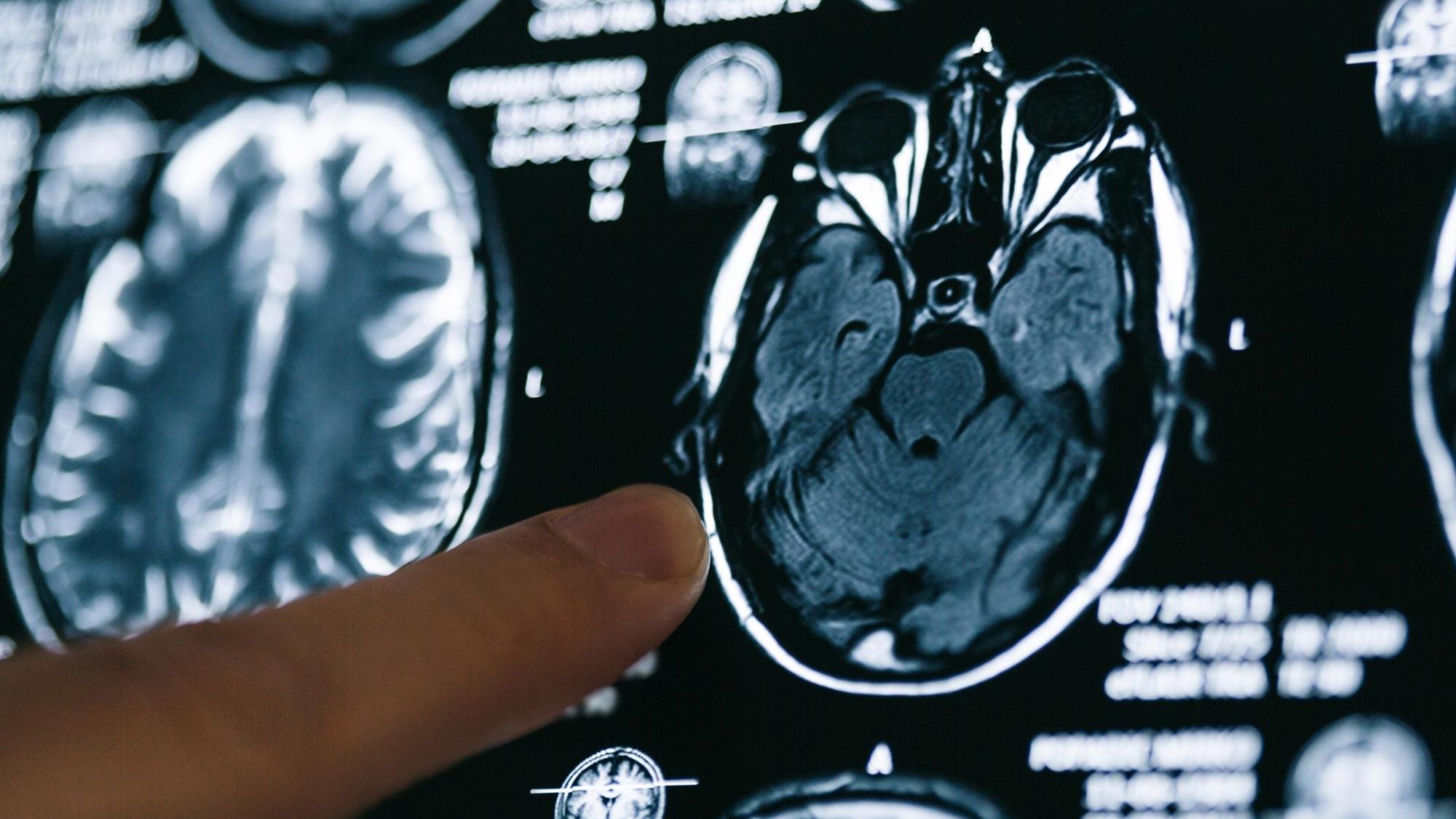 COVID-19 «съедает» серое вещество мозга у пациентов с тяжелыми симптомами 