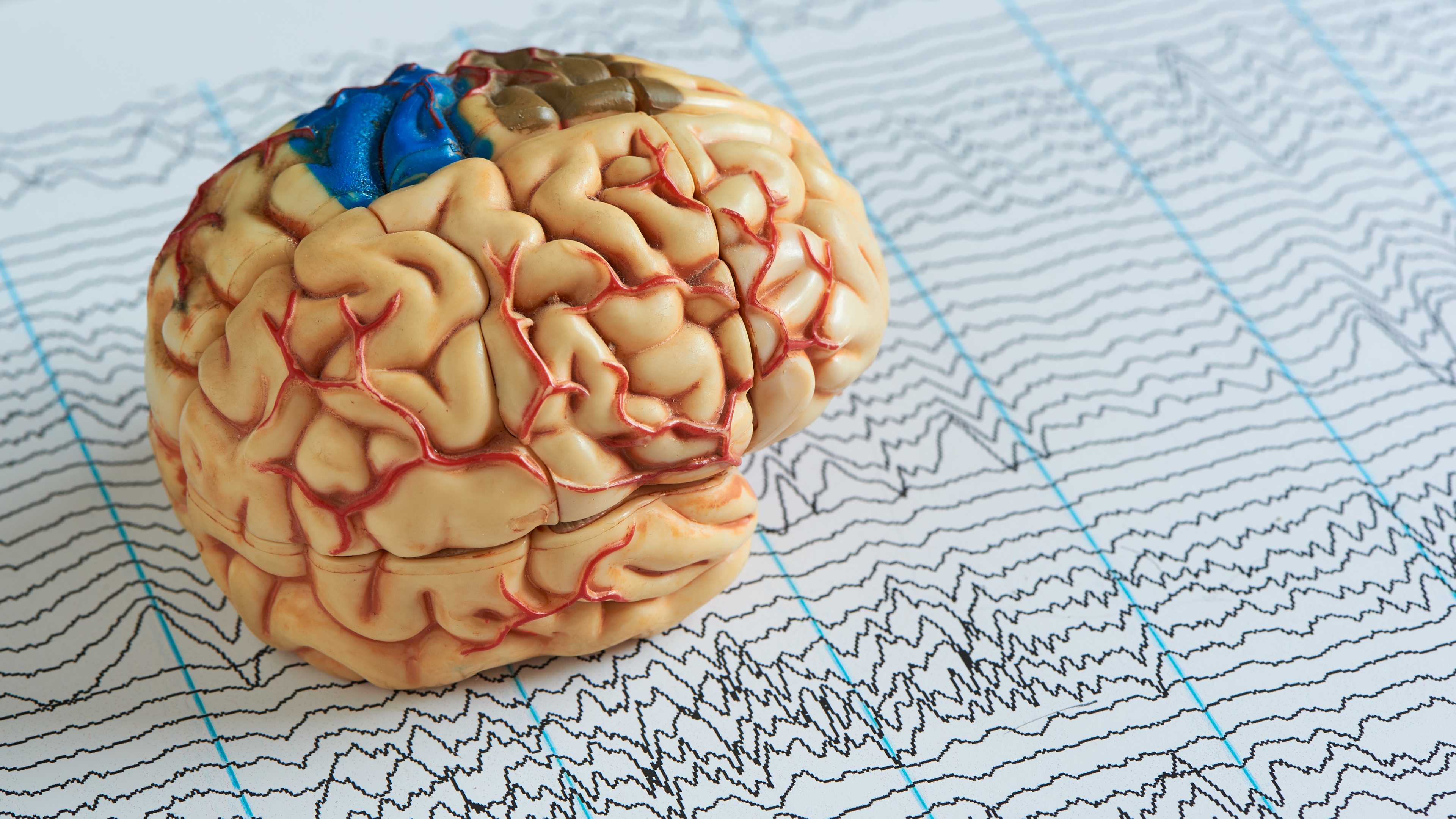 Судороги и провалы в памяти могут быть связаны с одной аномалией в мозгу при эпилепсии