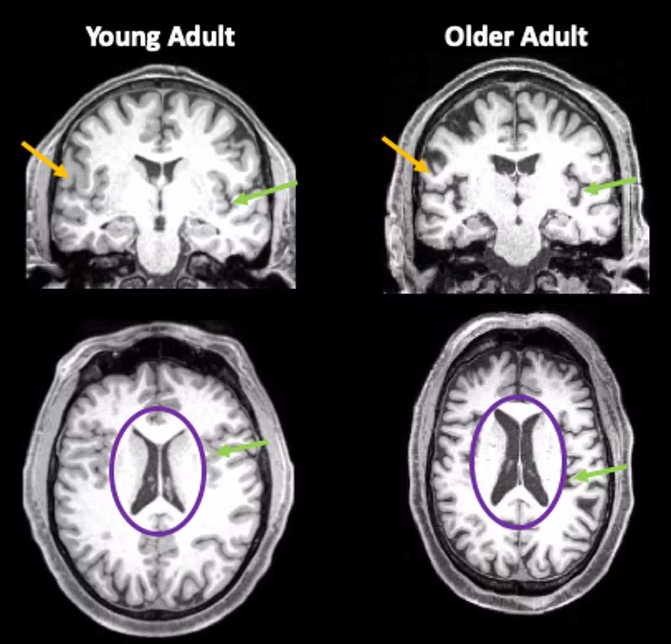 COVID-19 ускоряет старение мозга