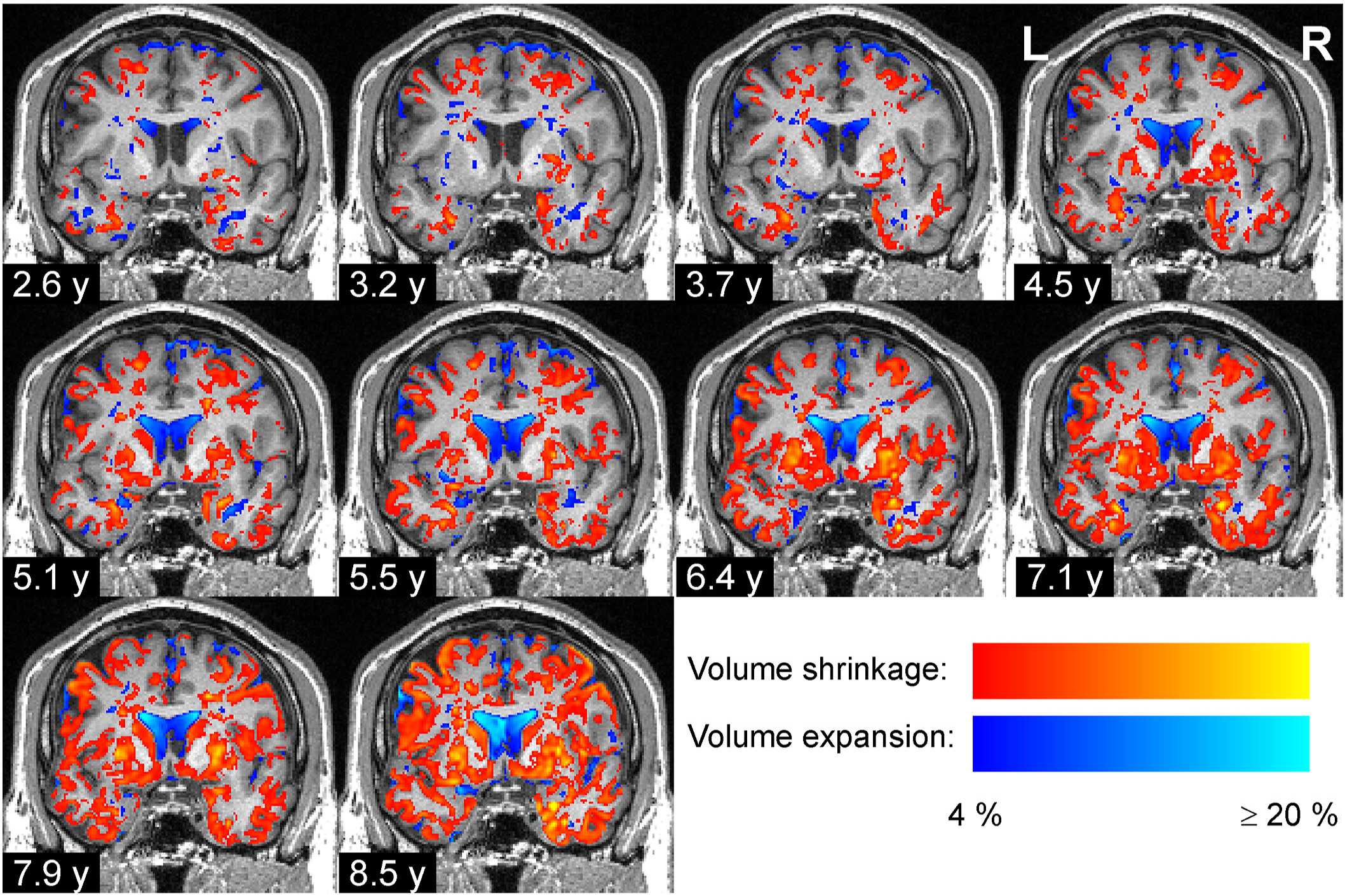 Как меняются объемы некоторых областей мозга при болезни Паркинсона