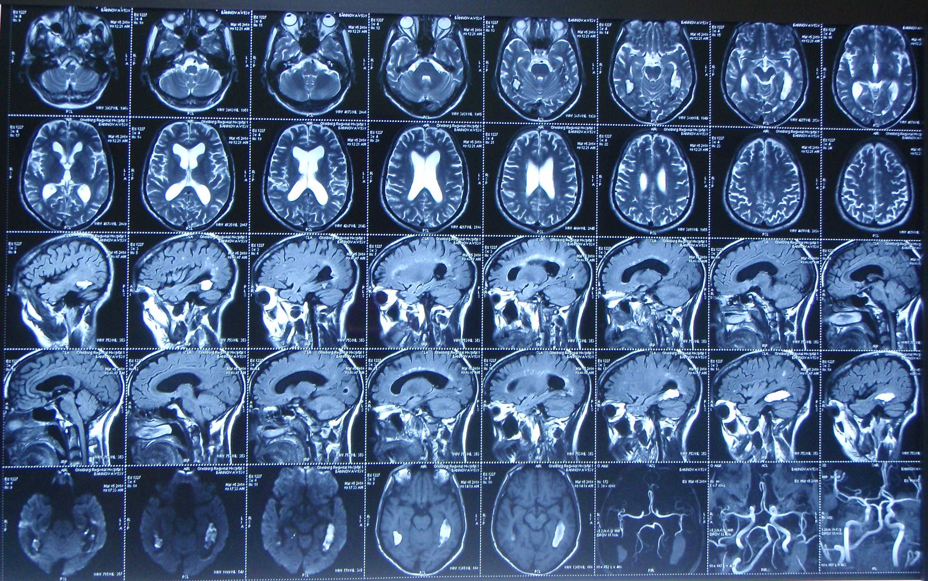 Найти болезнь Альцгеймера на МРТ поможет радиомика