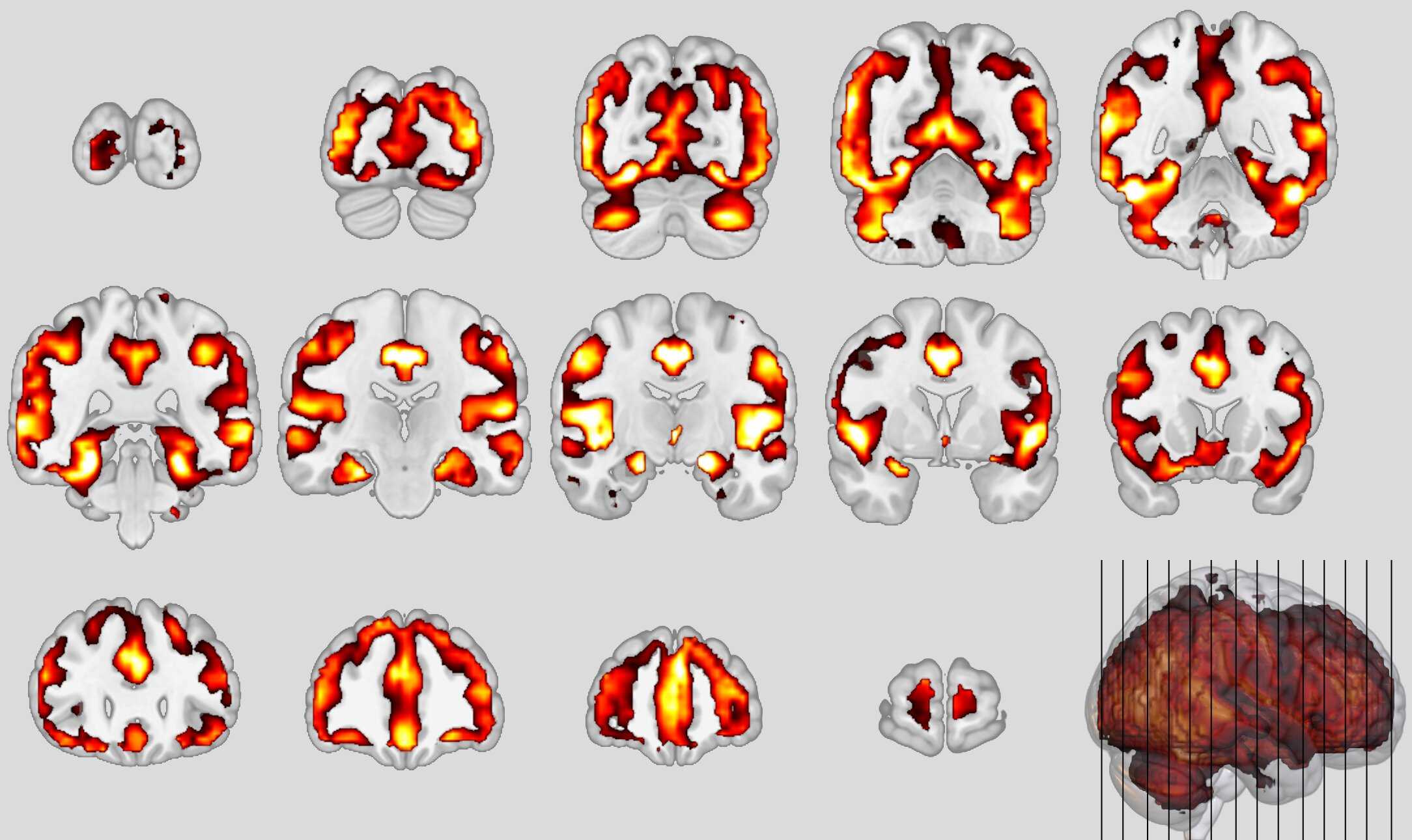 Впервые обнаружено сходство между шизофренией и деменцией