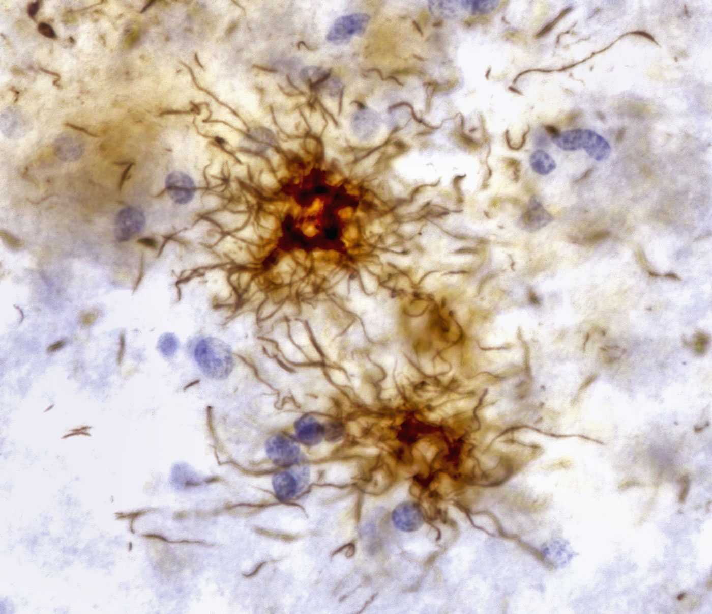 Белковые сгустки, связанные с болезнью Альцгеймера, влияют на старение всех клеток