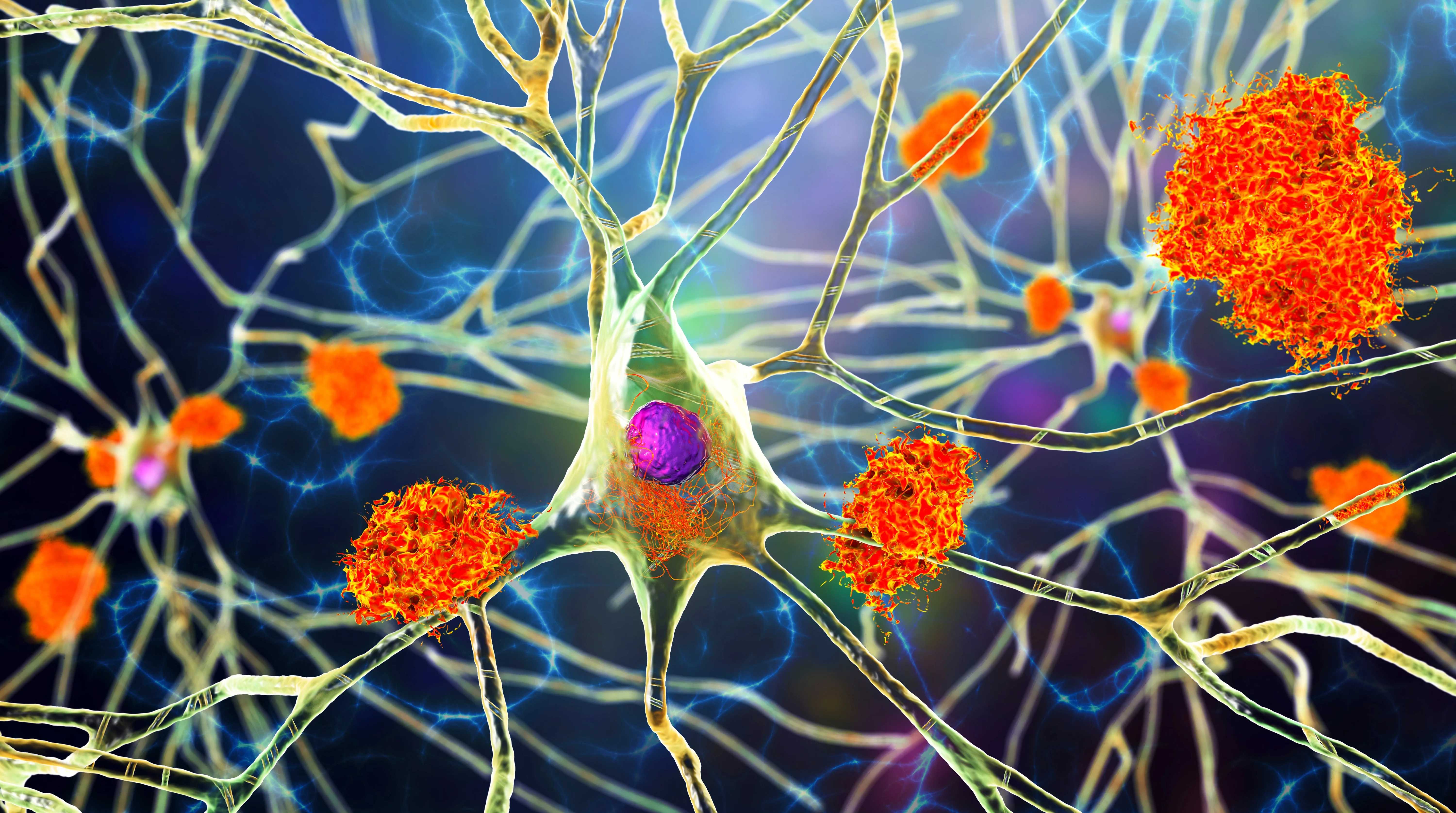 Как альцгеймерический ген мешает работать нейронам