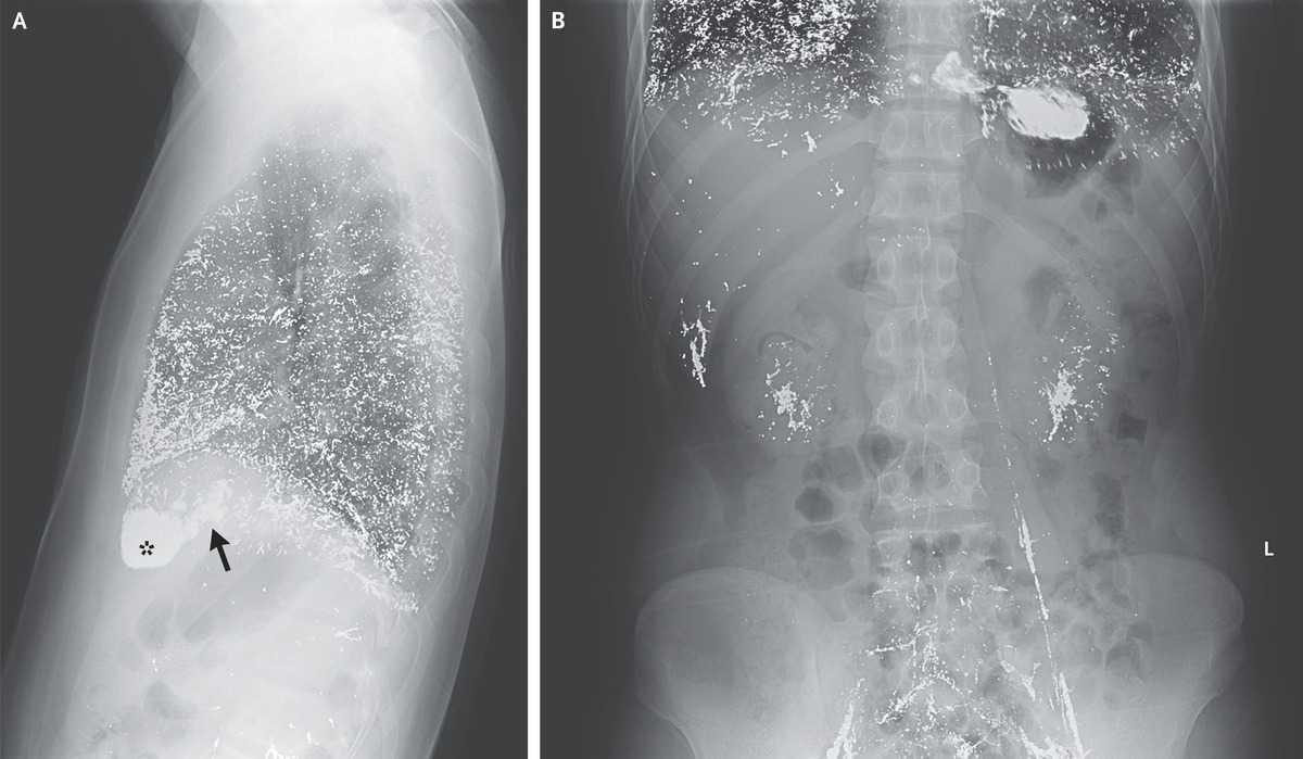 Китаец попытался вылечить грибок в паху внутривенной инъекцией ртути