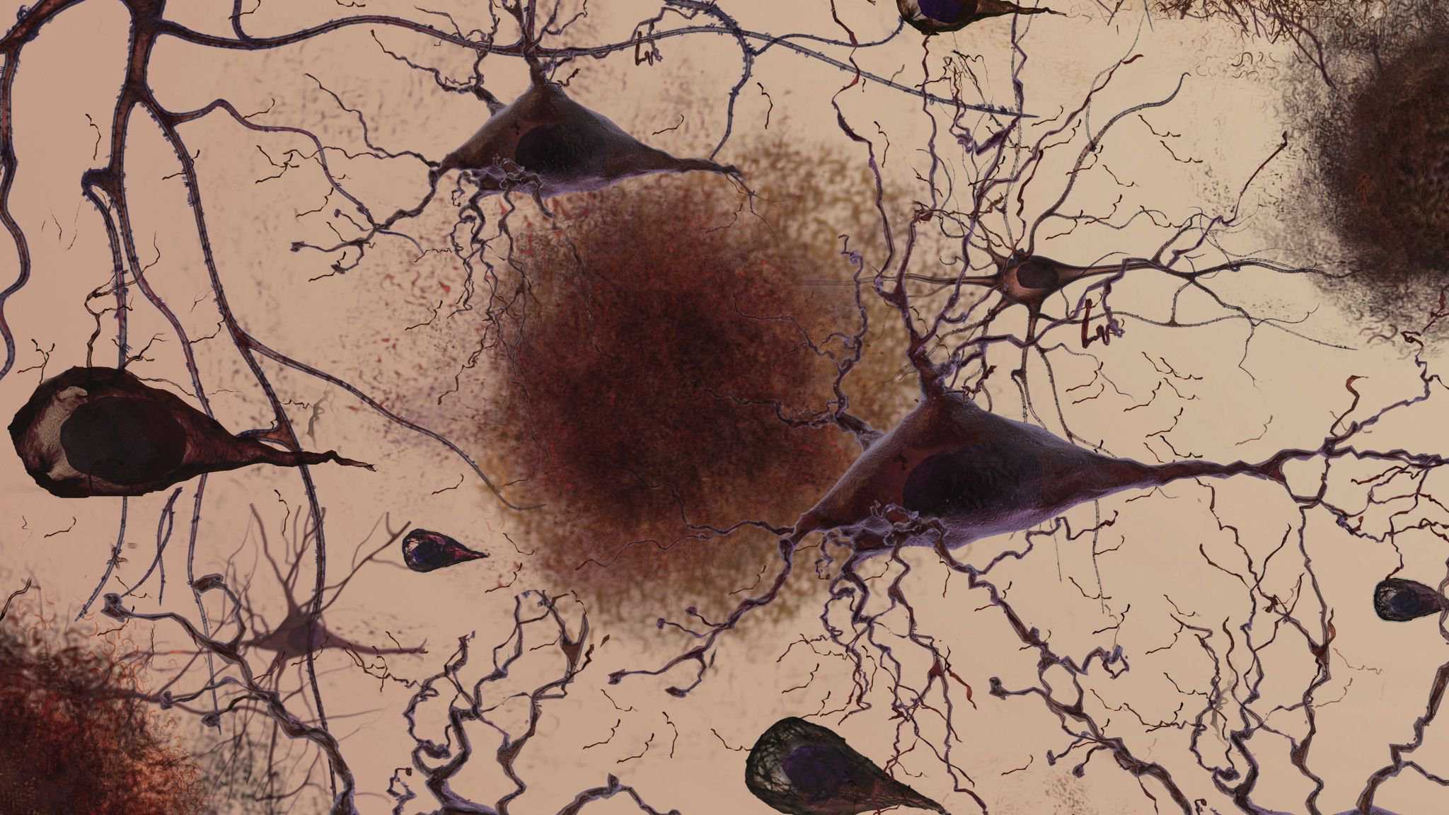 Ученые выяснили, какие участки мозга наиболее уязвимы для болезни Альцгеймера