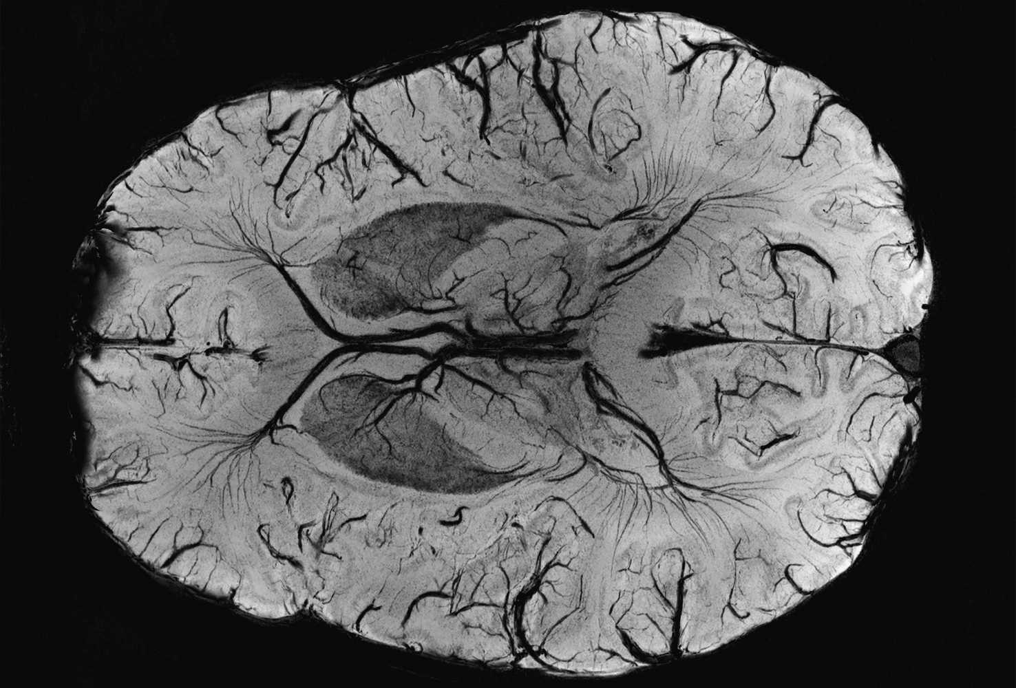 Аномалии мозга после Covid-19 обнаружили на снимках МРТ