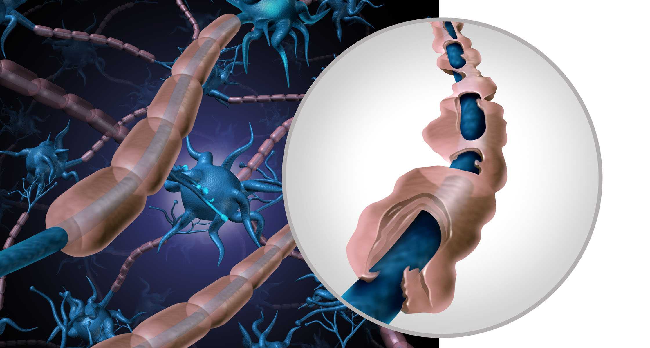 Как вирус Эпштейна-Барр вызывает развитие рассеянного склероза