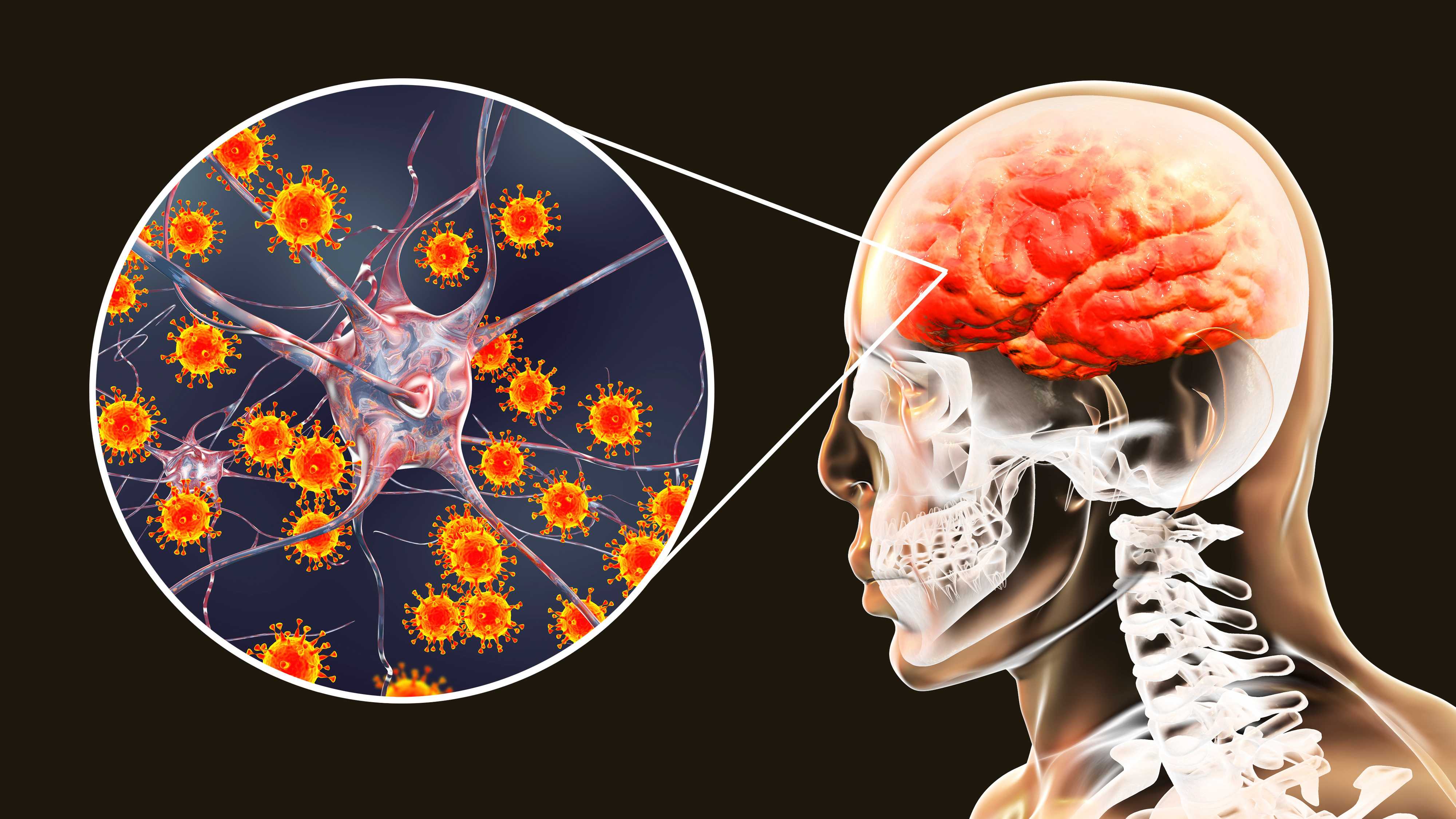Нормальный вирус кори помог мутантному вызвать подострый склерозирующий панэнцефалит