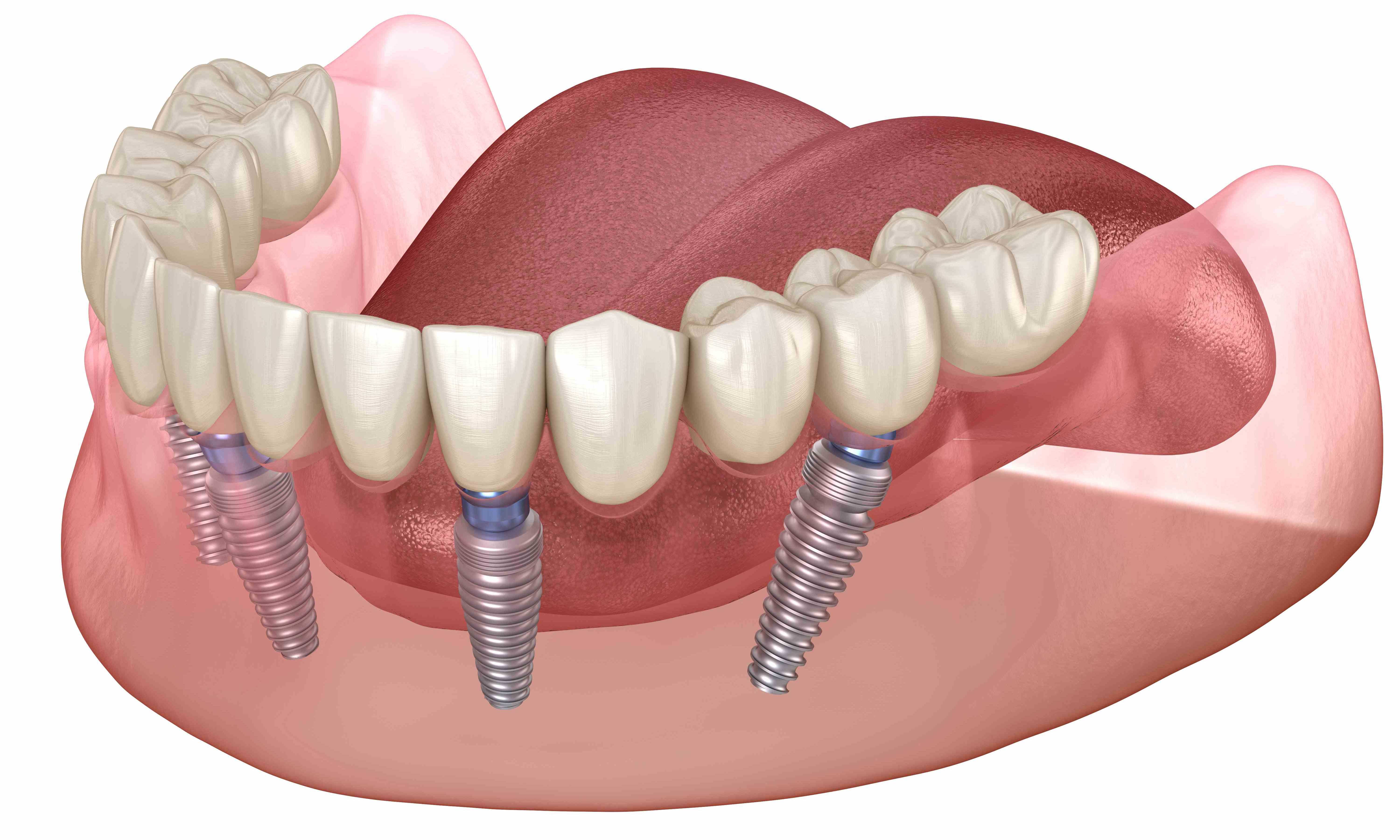 Имплантация зубов как реставрация эстетики и комфорта