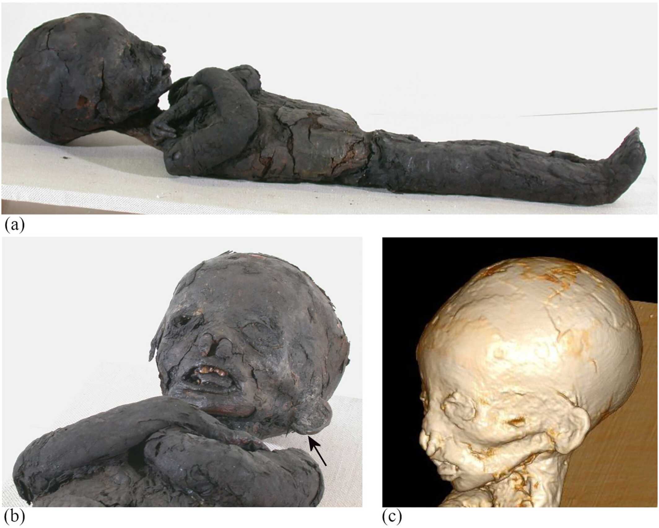 У древнеегипетского мальчика с аномально большим языком диагностировали бета-талассемию