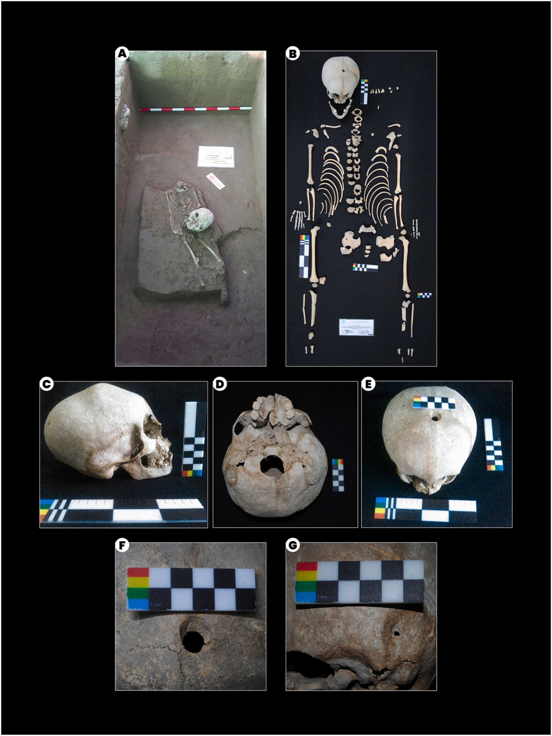 В Колумбии нашли жившего тысячу лет назад ребенка с двумя отверстиями в черепе