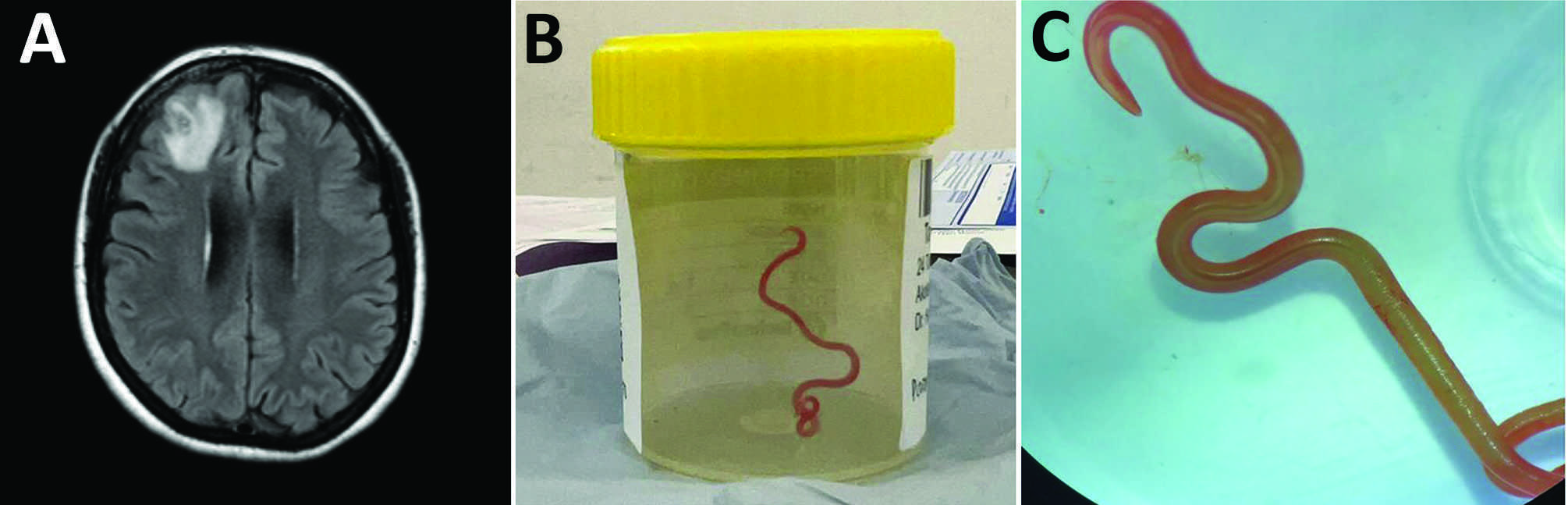 Живого червя Ophidascaris robertsi впервые удалили из мозга человека. Он пробыл там год