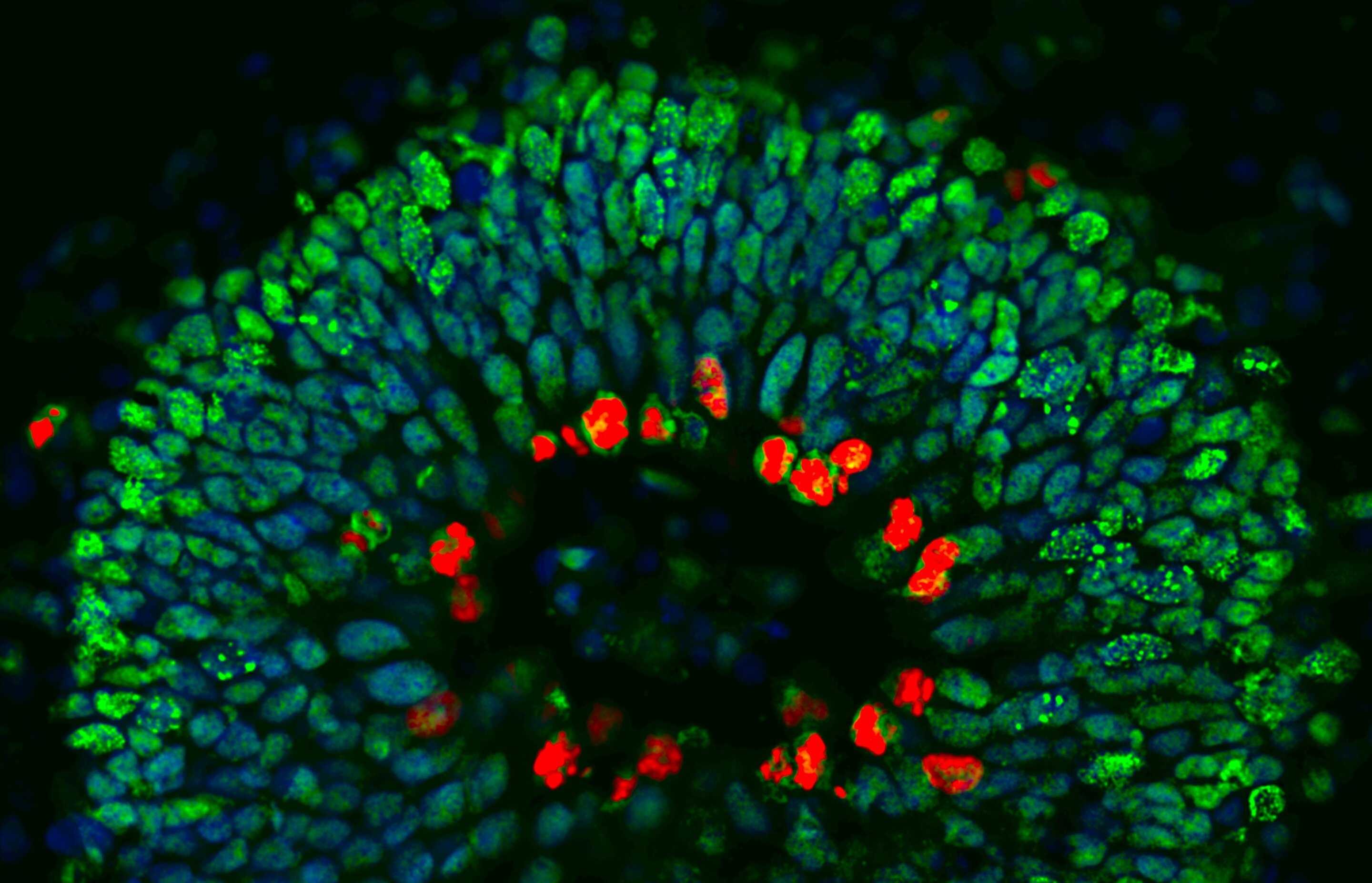 Деменция «в чашке Петри»: органоиды позволили найти мутацию нейродегенерации