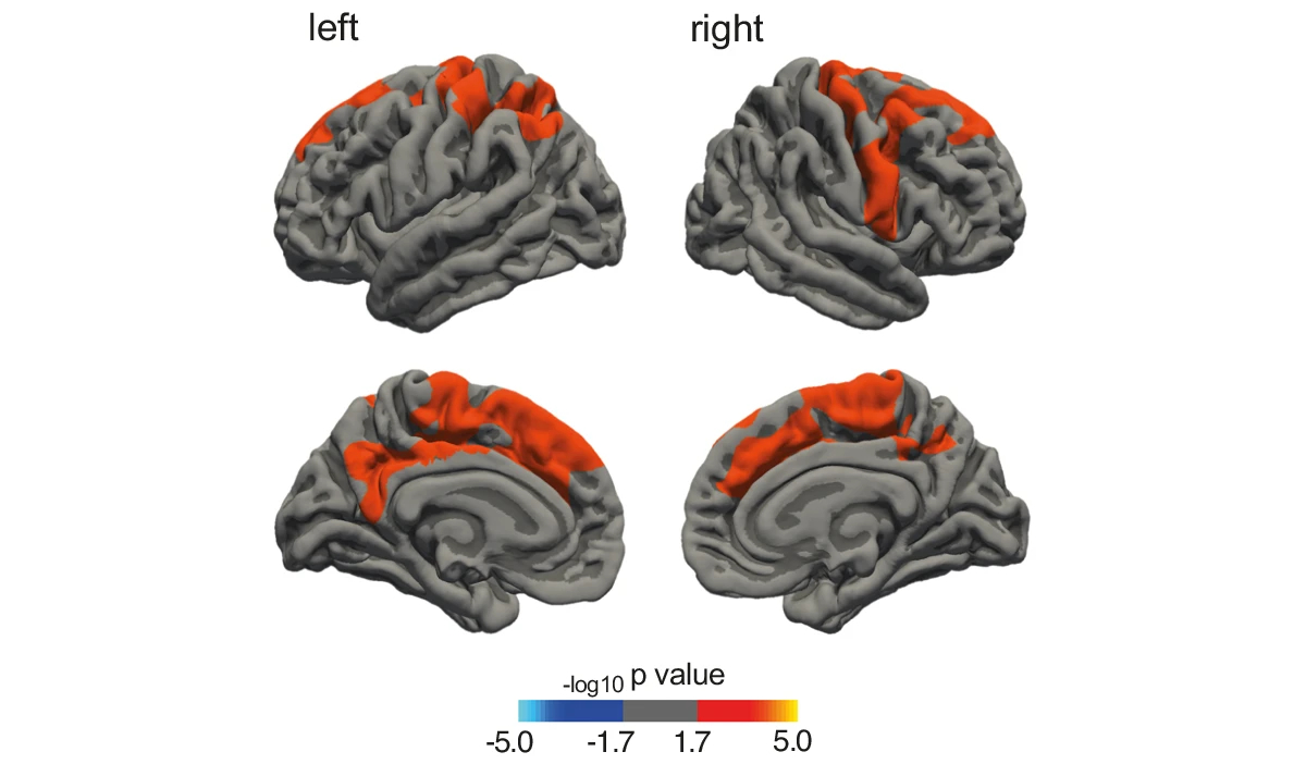 Эстроген защищает женщин от болезни Паркинсона Эстроген защищает женщин от болезни Паркинсона