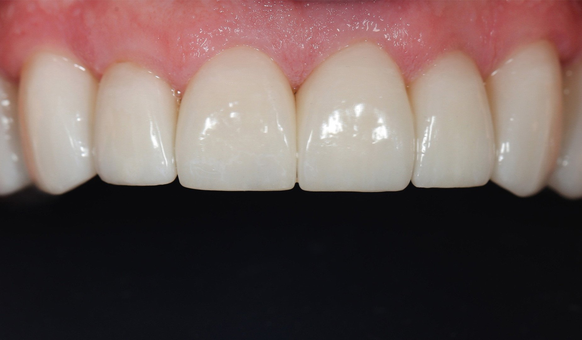 Какое отбеливание зубов эффективнее? Какое отбеливание зубов эффективнее?