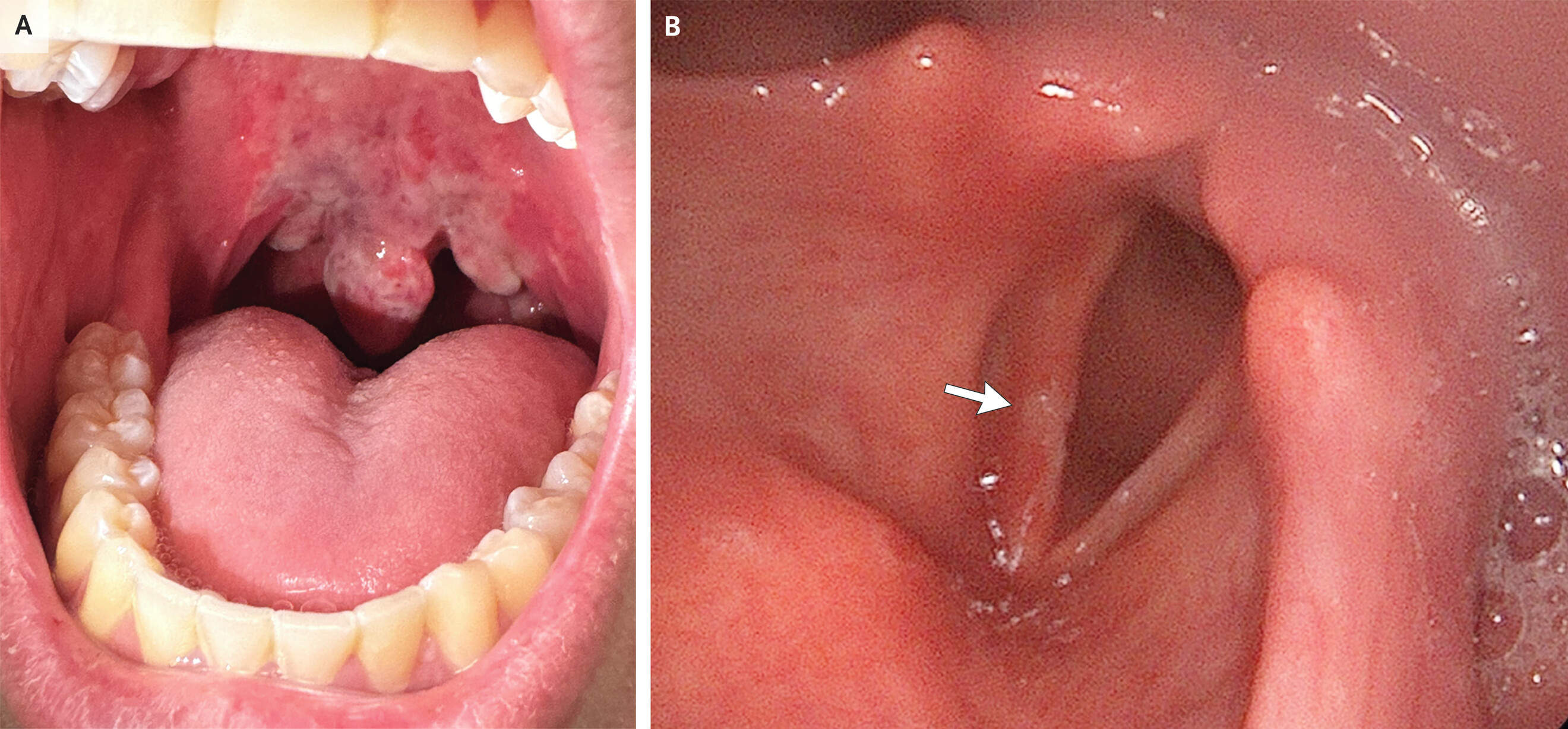 Веселящий газ вызвал обморожение глотки и гортани Веселящий газ вызвал обморожение глотки и гортани
