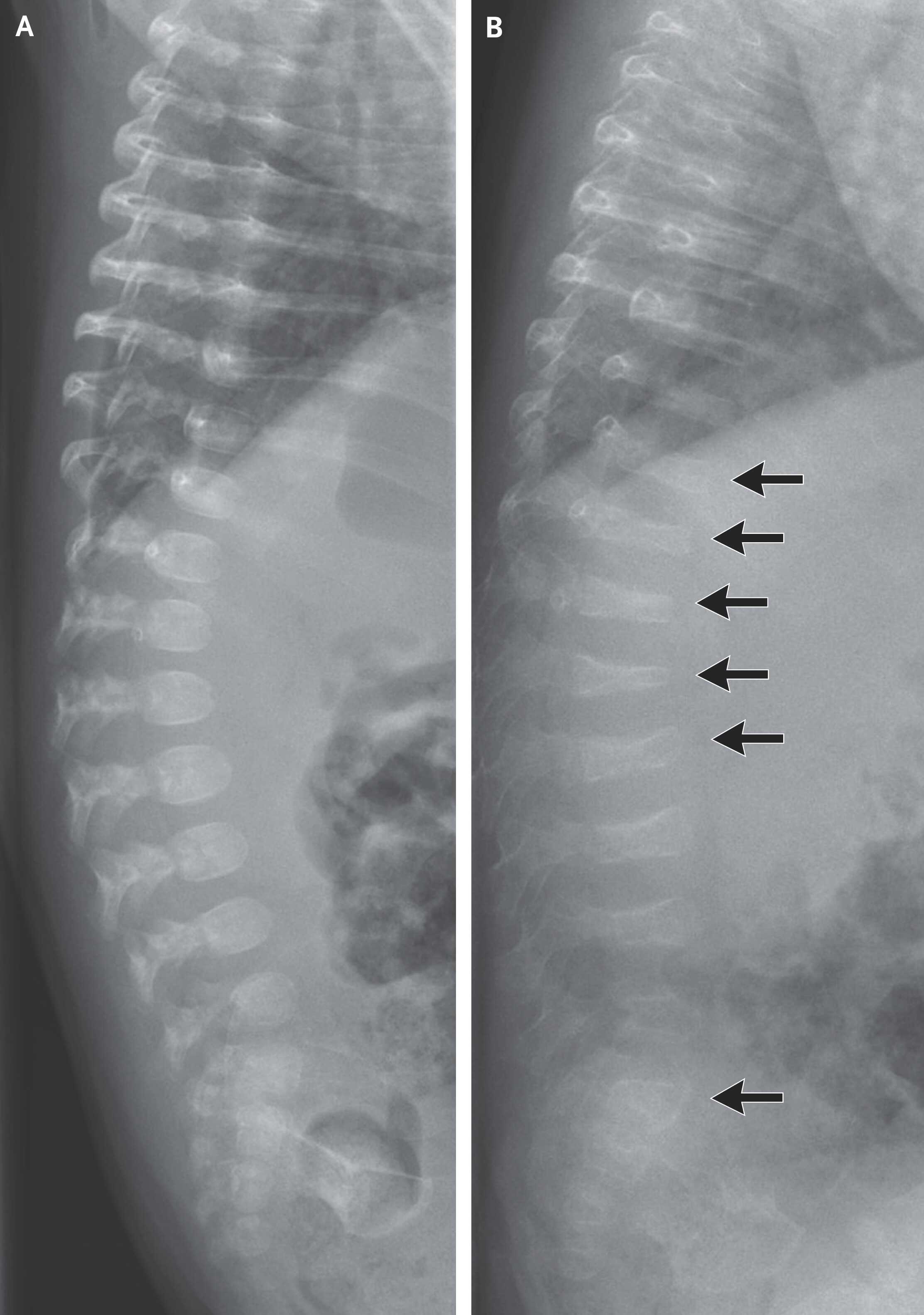 Немецкие врачи помогли младенцу с несовершенным остеогенезом Немецкие врачи помогли младенцу с несовершенным остеогенезом
