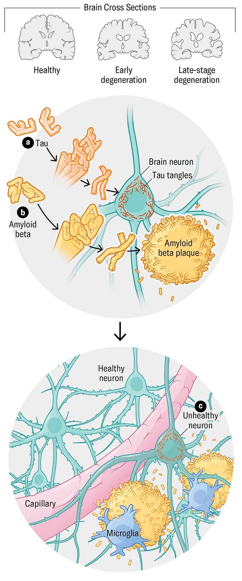 Новые горизонты в терапии болезни Альцгеймера Новые горизонты в терапии болезни Альцгеймера