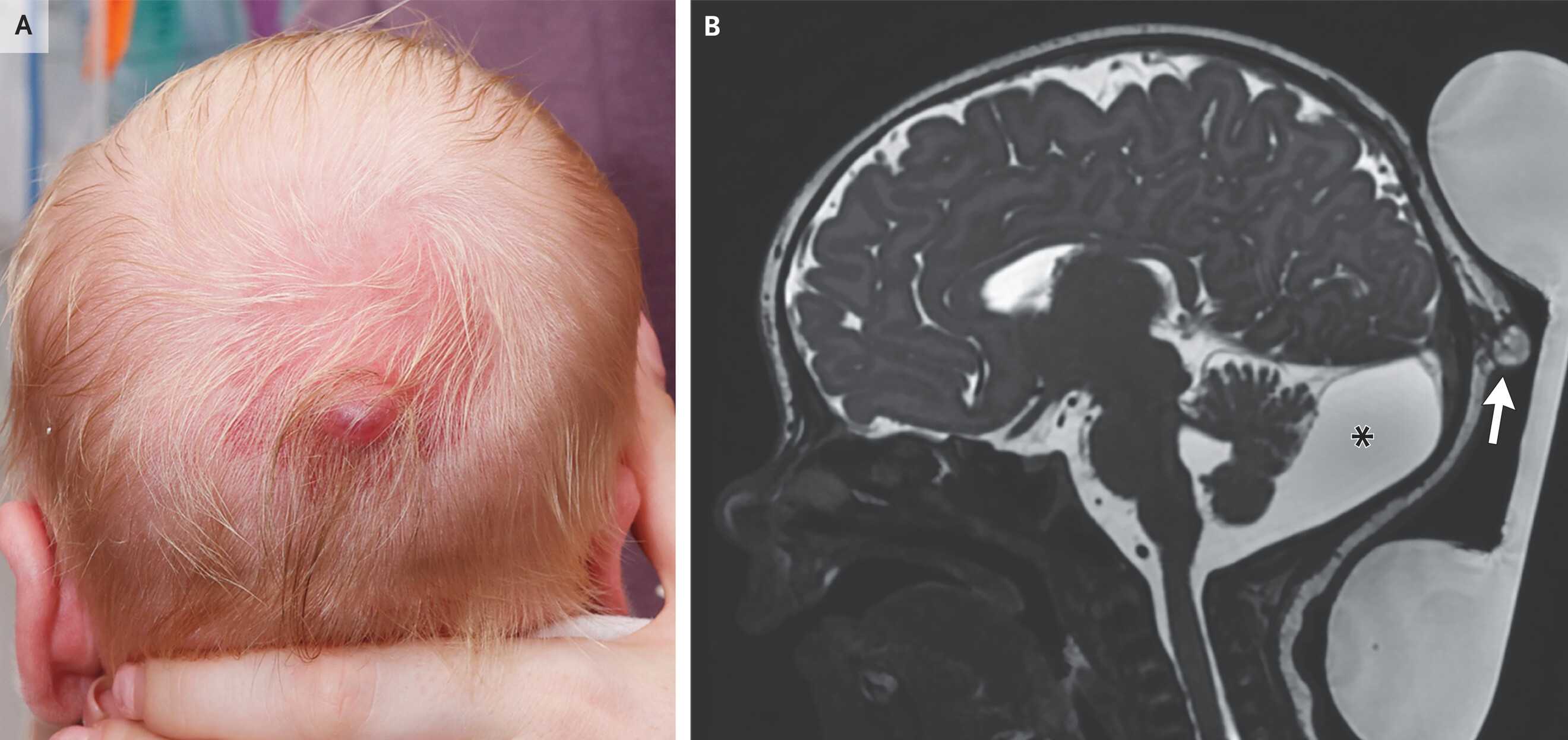 Ирландские врачи вылечили младенца с грыжей мозговых оболочек под кожей головы Ирландские врачи вылечили младенца с грыжей мозговых оболочек под кожей головы