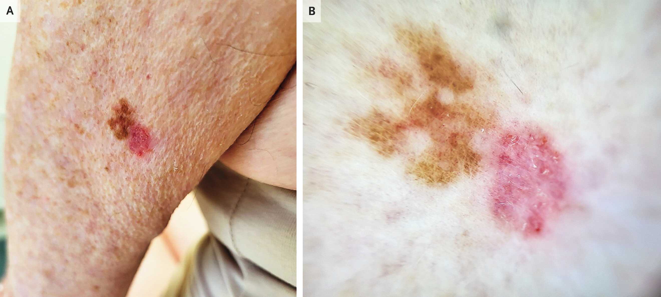 Две злокачественных опухоли столкнулись на коже ирландки. Их успешно удалили Две злокачественных опухоли столкнулись на коже ирландки. Их успешно удалили